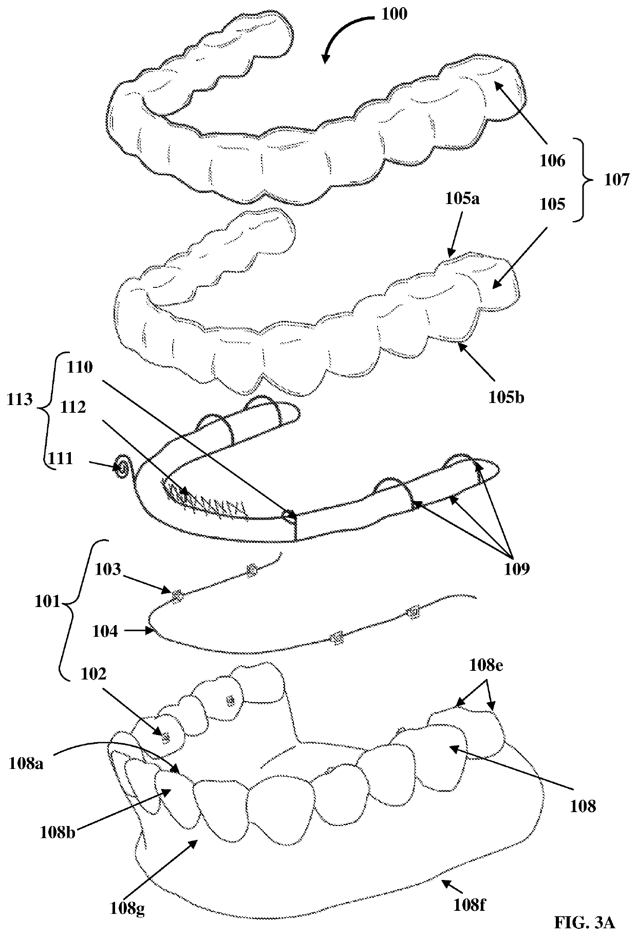 Detachable Orthodontic Bracket And Wire System