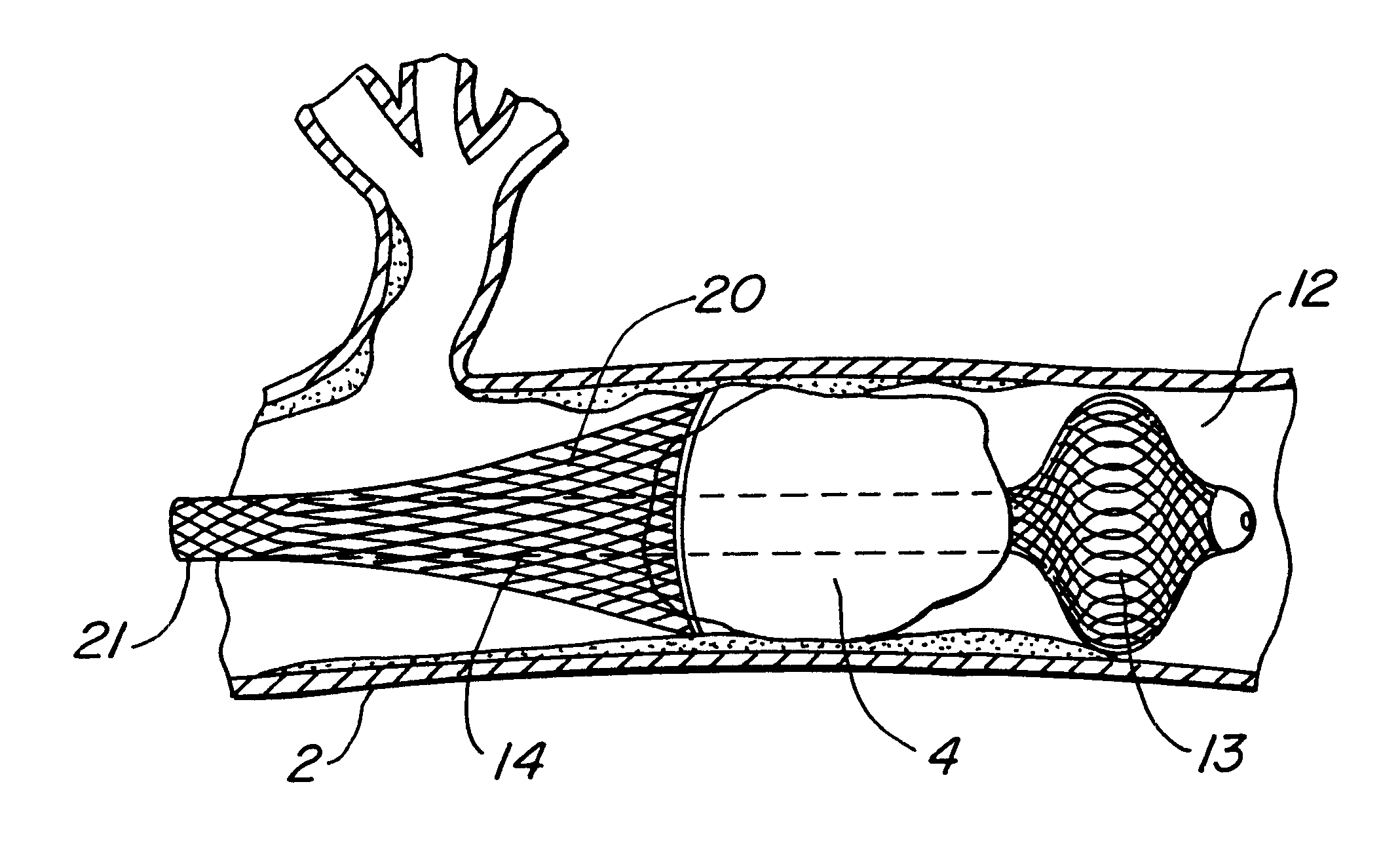 Medical device and methods for use