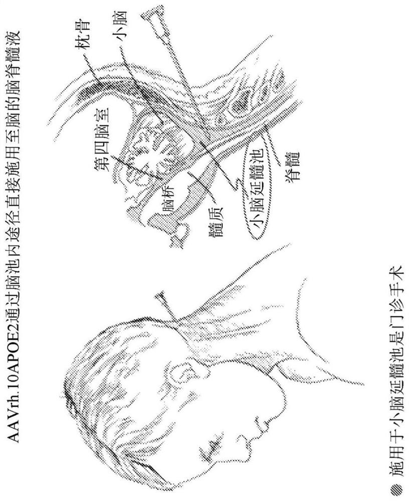 APOE gene therapy