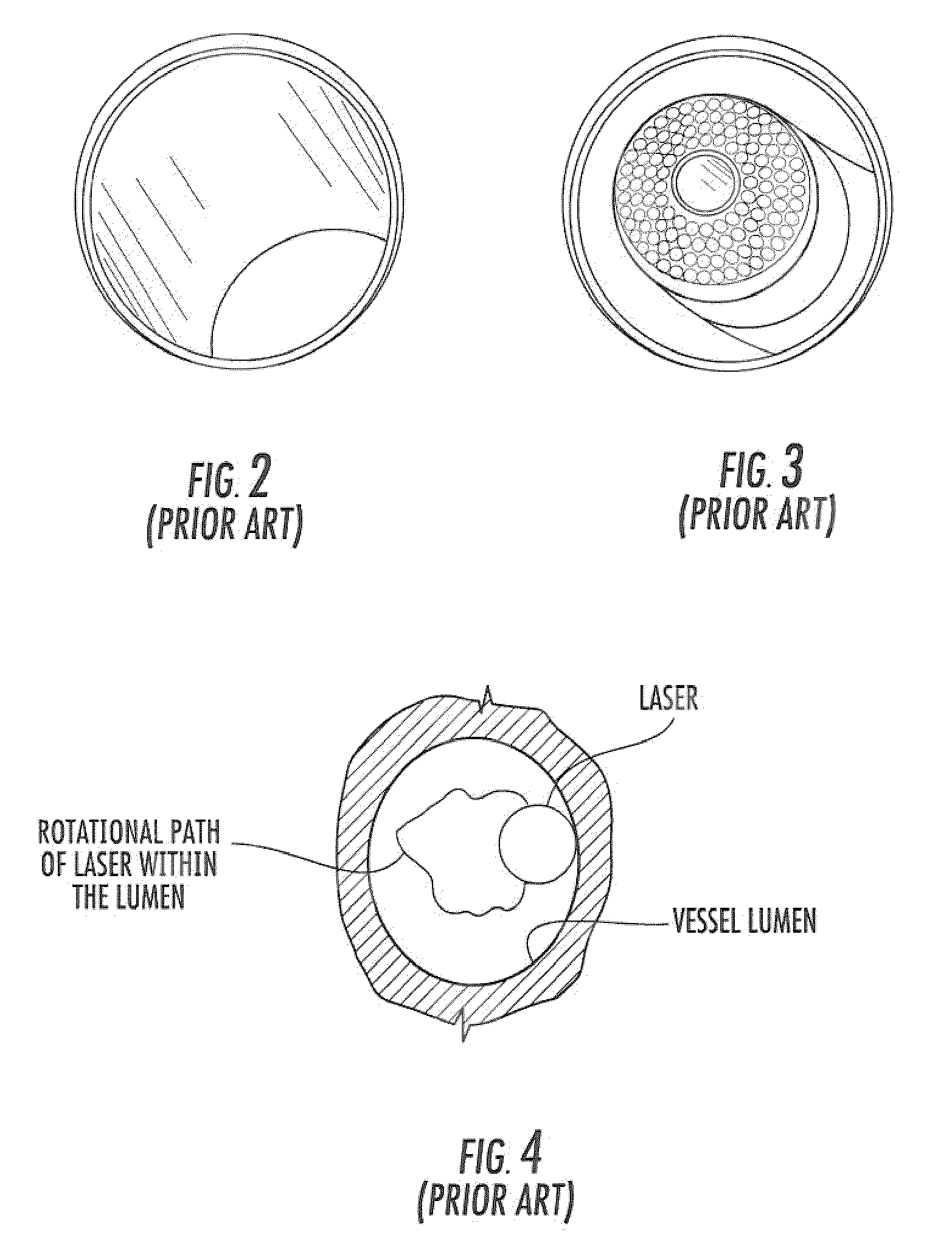 Laser Catheter with an Adjustable Distal Tip for Increasing the Laser Target Zone