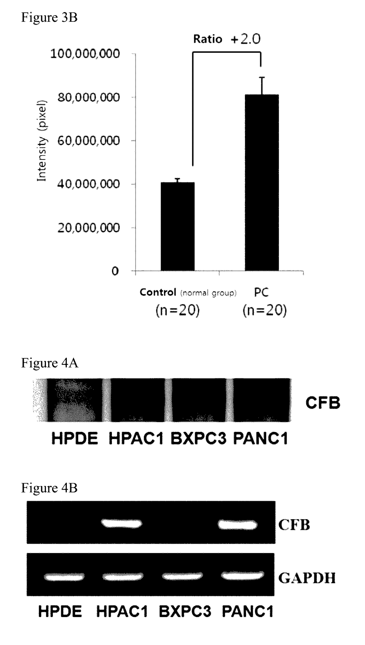 Kit comprising antibody specifically binding to complement factor b protein and antibody specifically binding to carbohydrate antigen 19-9 protein for diagnosing pancreatic cancer