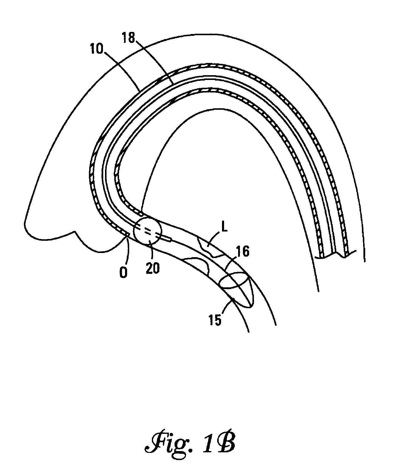 Catheter with occluding cuff