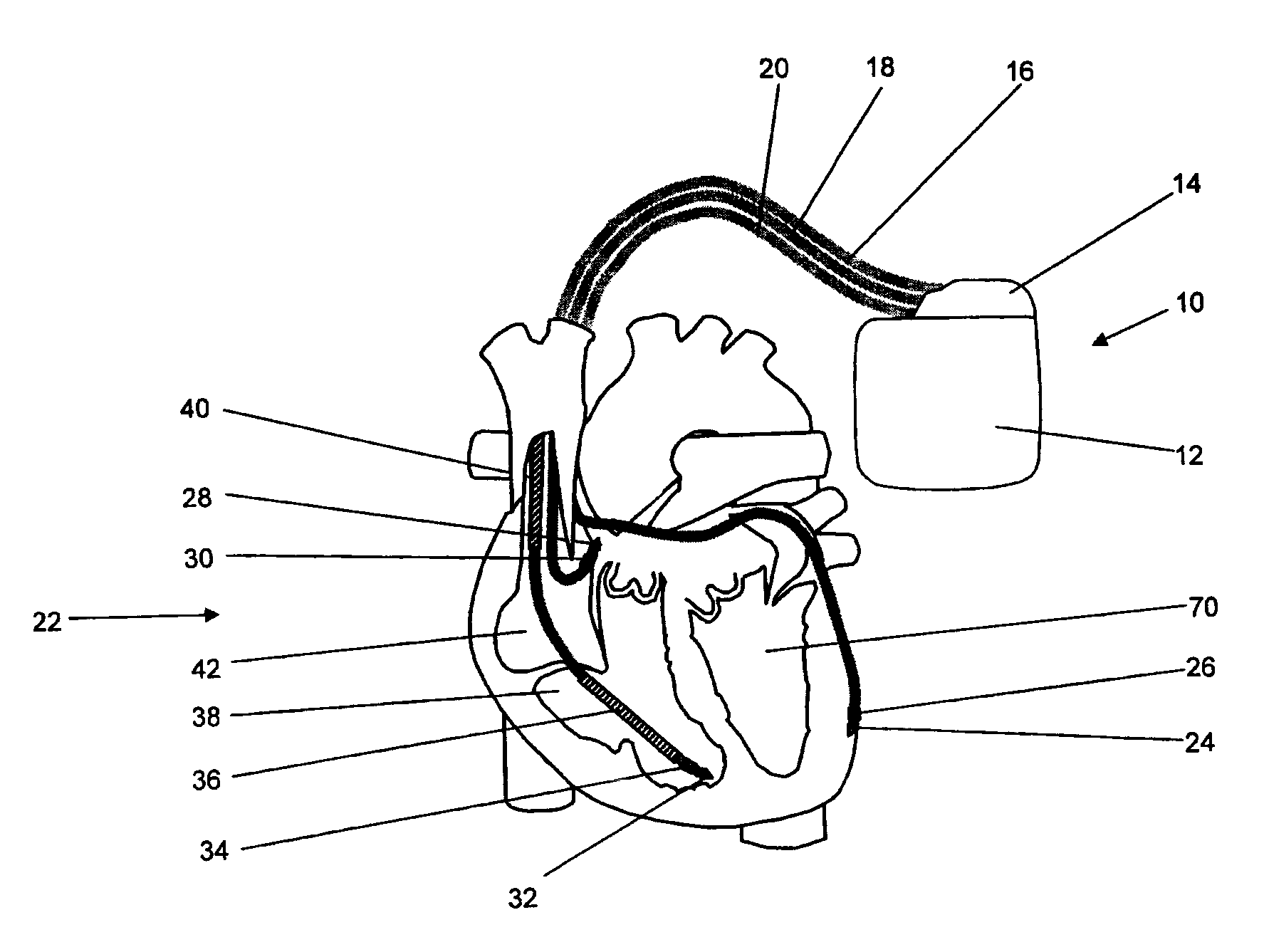 Implantable medical device and method for lv coronary sinus lead implant site optimization