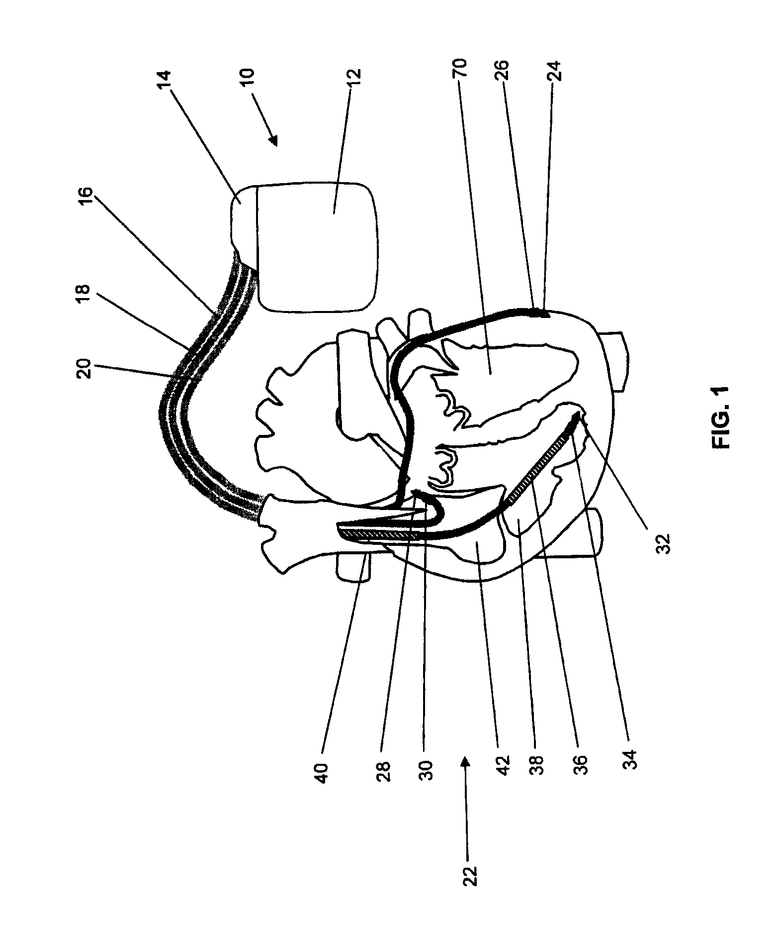 Implantable medical device and method for lv coronary sinus lead implant site optimization