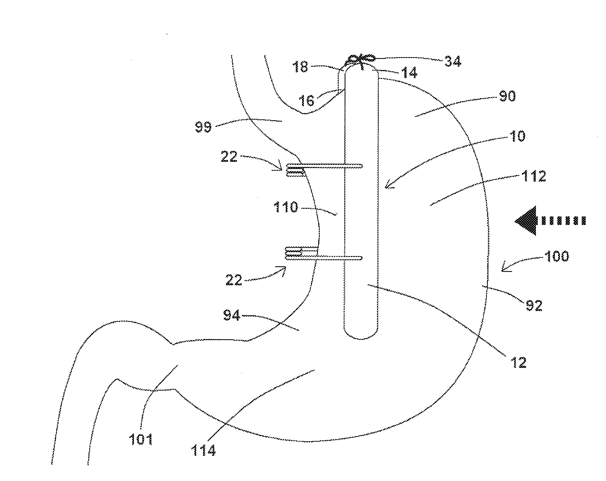 Devices, systems, and methods for engaging a tissue