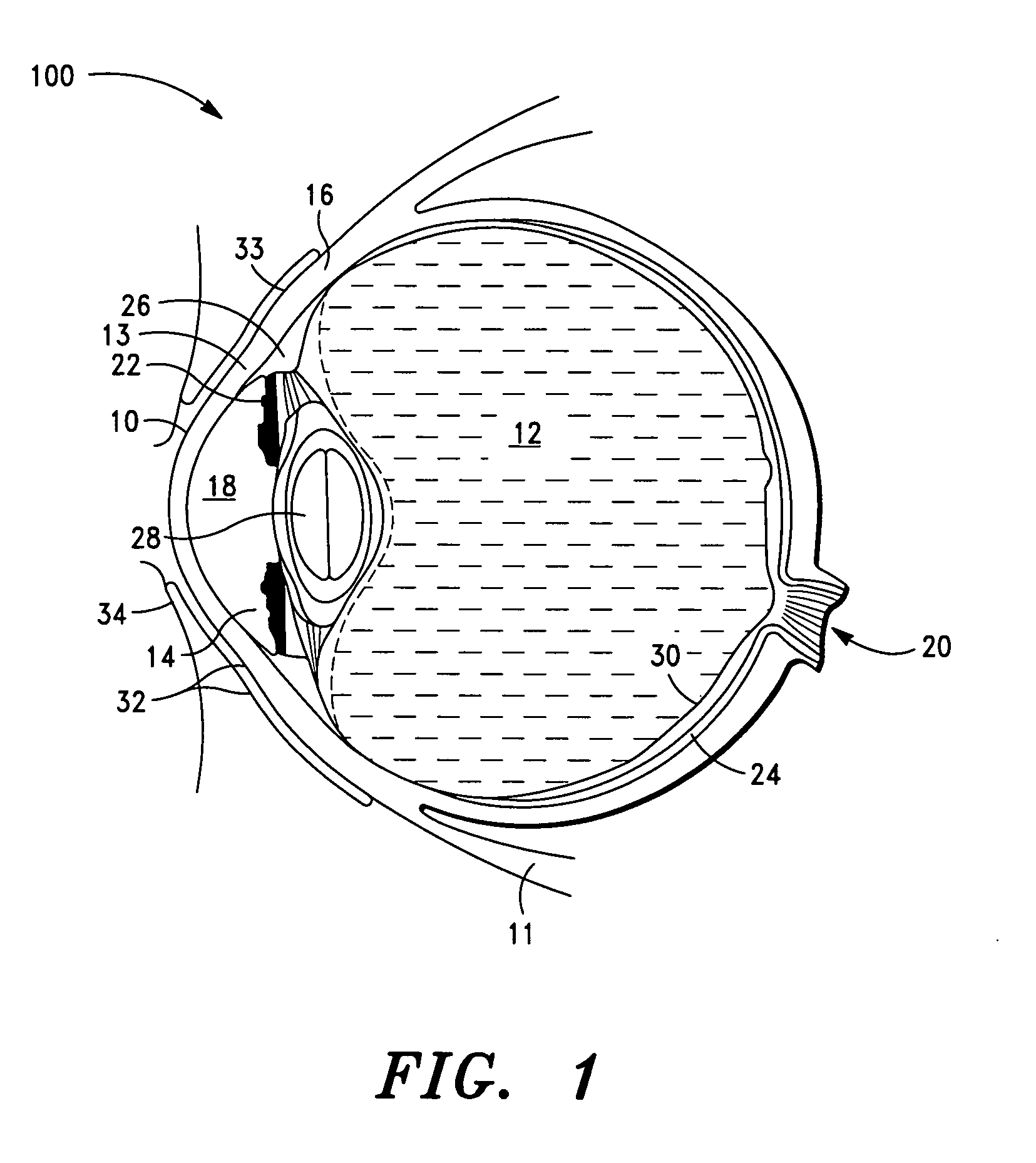 Subconjunctival agent delivery apparatus, system and method