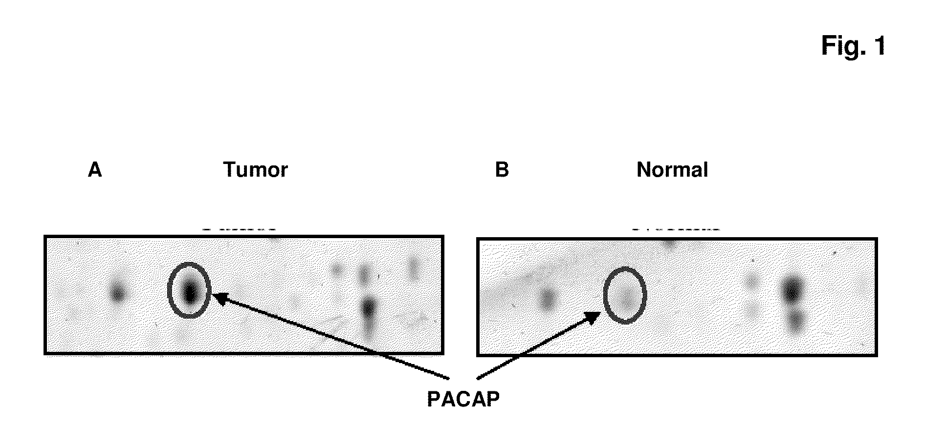 Pacap as a marker for cancer