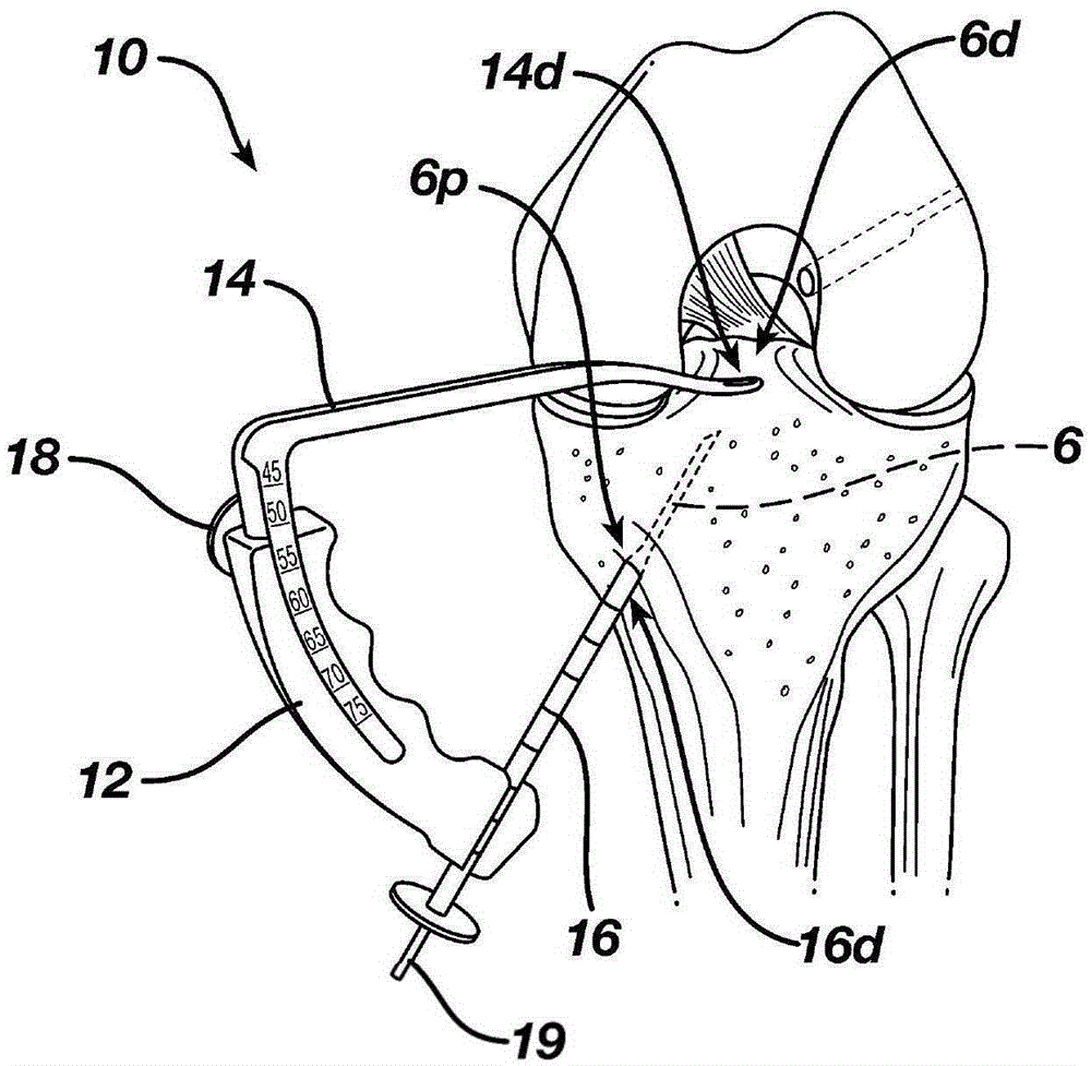 Surgical Guide for Use in Ligament Repair Procedures
