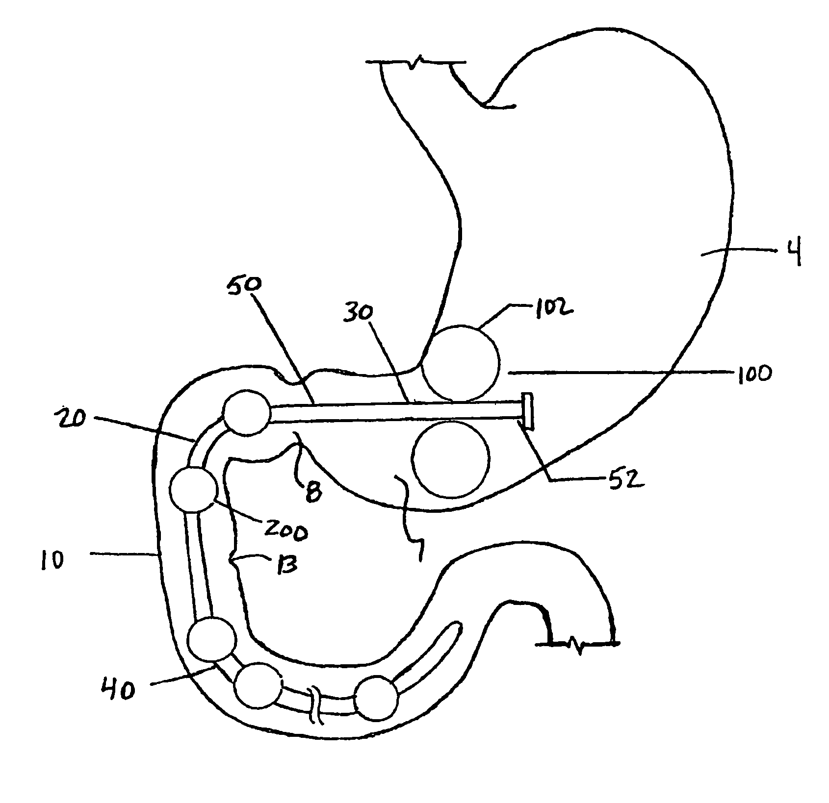 Methods and devices to curb appetite and/or reduce food intake