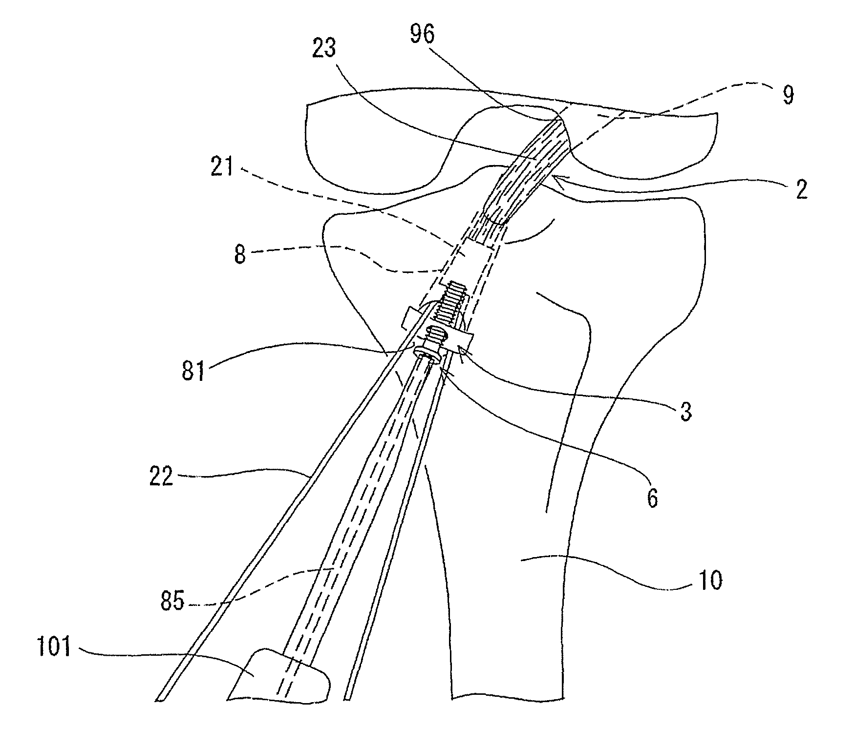 Tensile force-adjustable fixing tool for fixing tendon graft and ligament reconstruction method