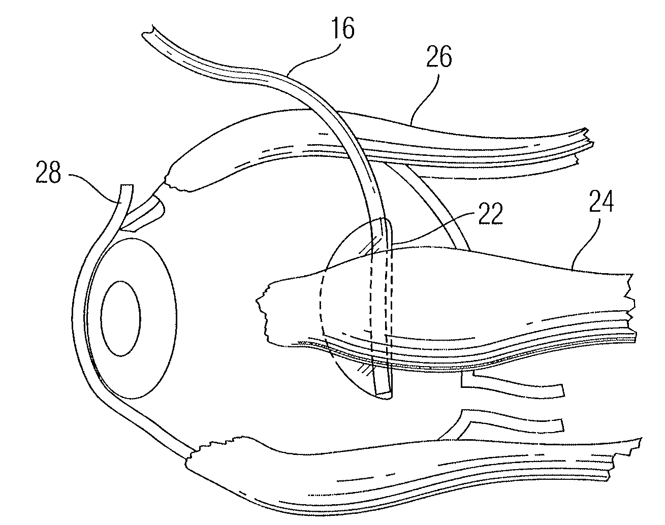 Implant for use in surgery for glaucoma and a method