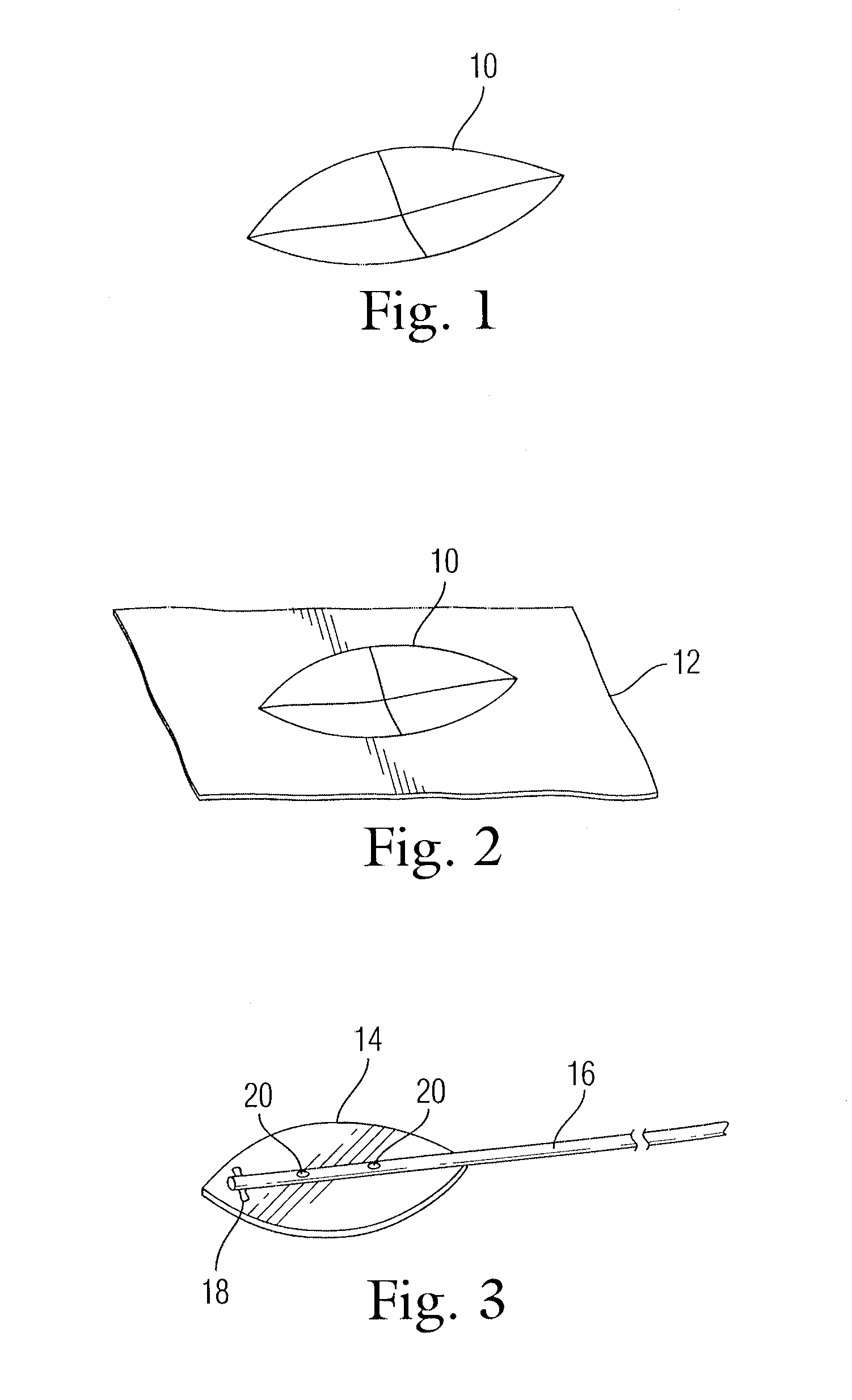 Implant for use in surgery for glaucoma and a method