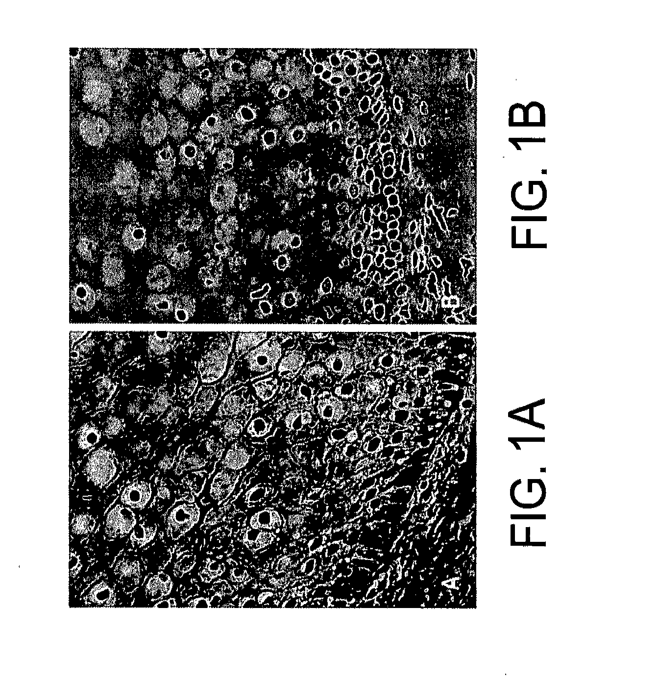 Kits for and methods of differential staining of cervical cancer cells and/or tissues