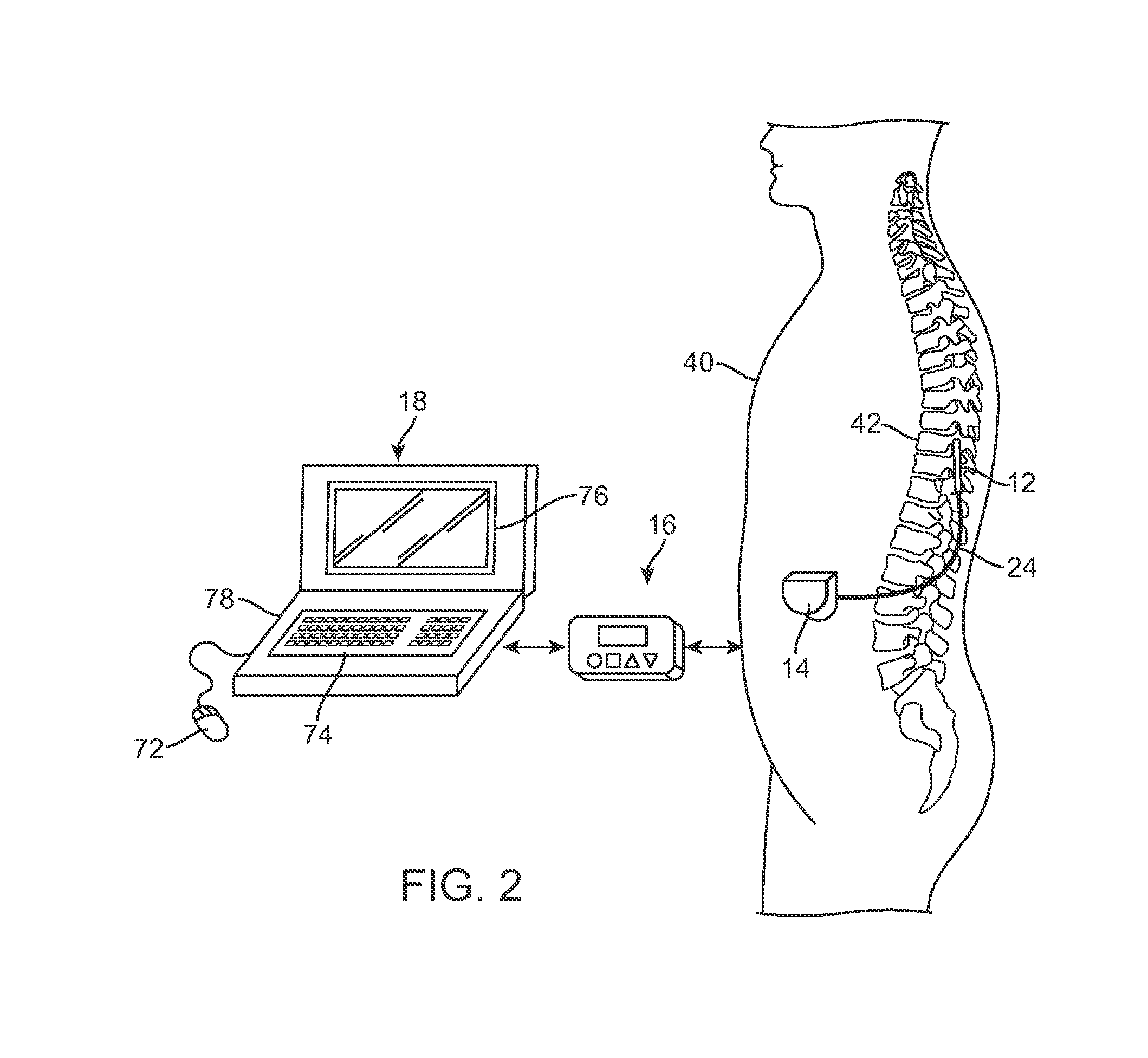 Systems and methods for delivering therapy to the dorsal horn of a patient