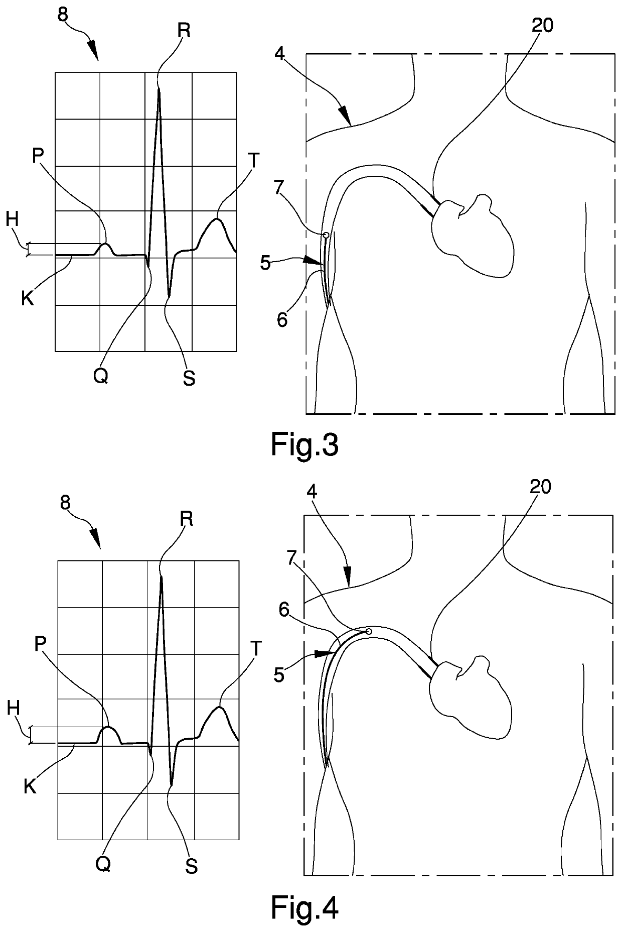 Medical apparatus for the introduction of catheters into the human body