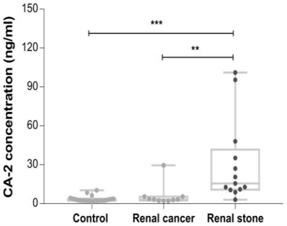 Application of carbonic anhydrase-2 as a detection marker in the diagnosis of kidney stones