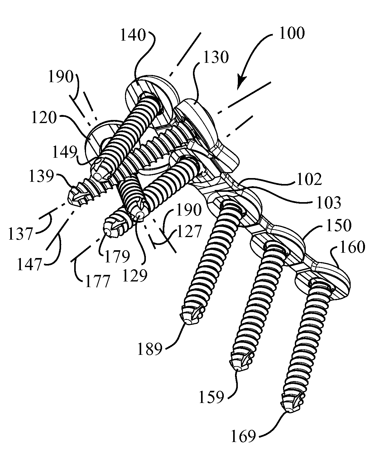 Elbow Fracture Fixation System