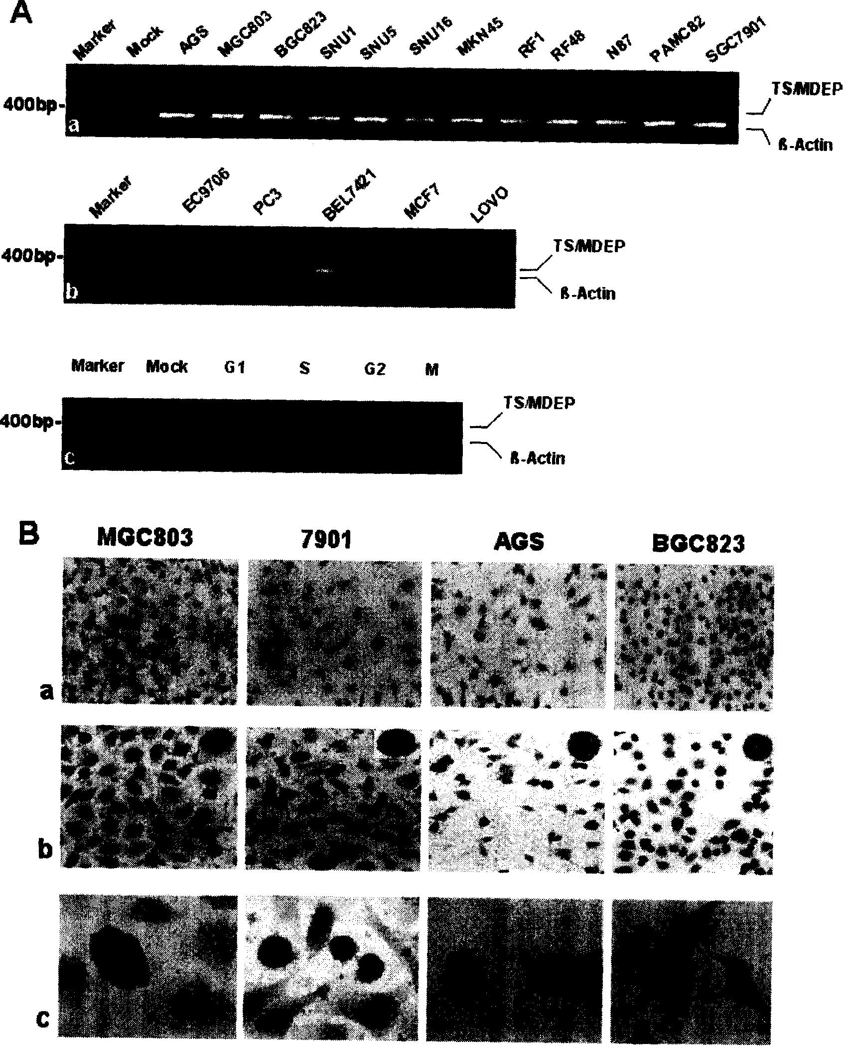 Preparation for antibody of antineoplastic specificity marker protein TS/MEDP and use thereof