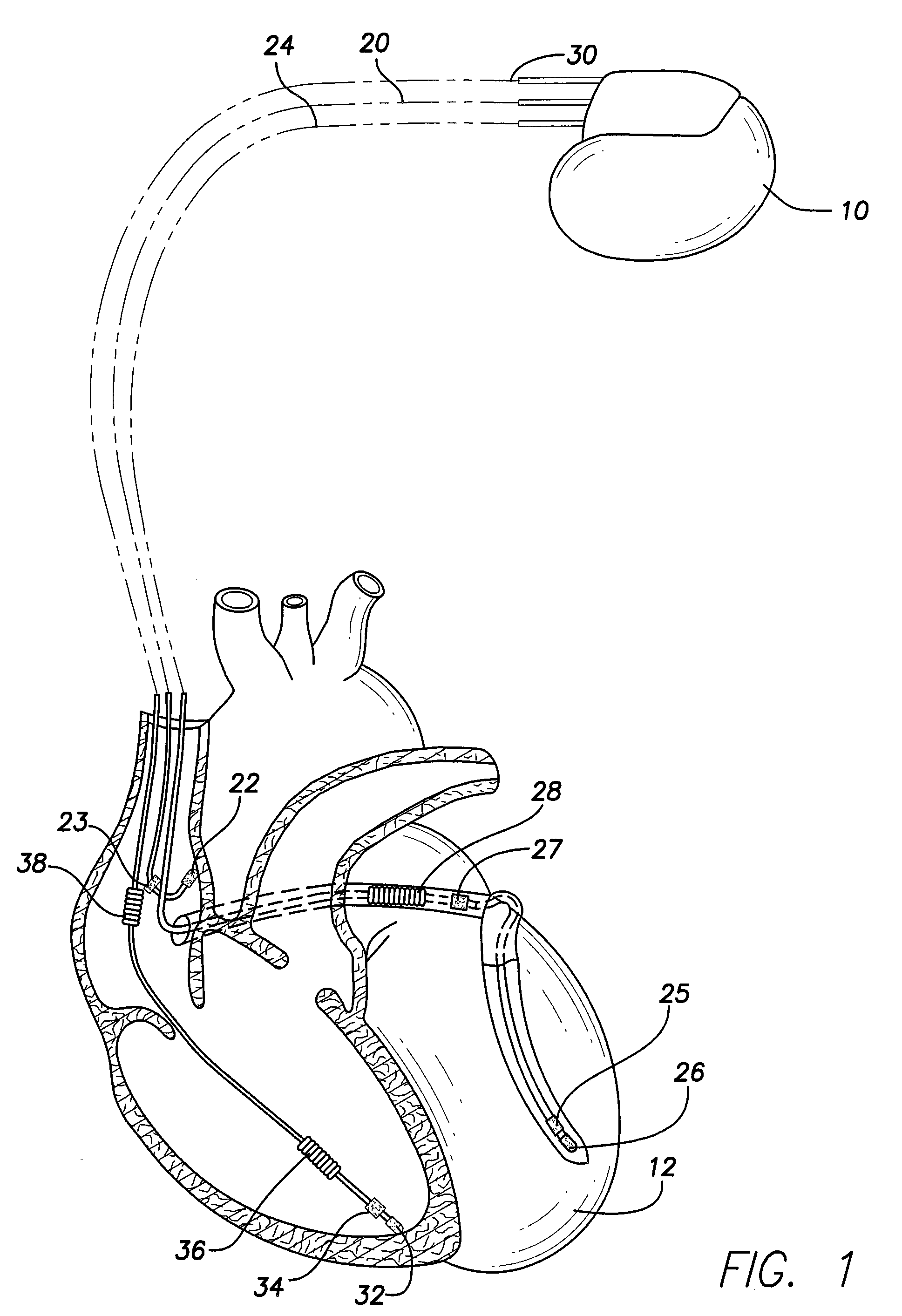 Methods and systems for implementing an SCR topology in a high voltage switching circuit