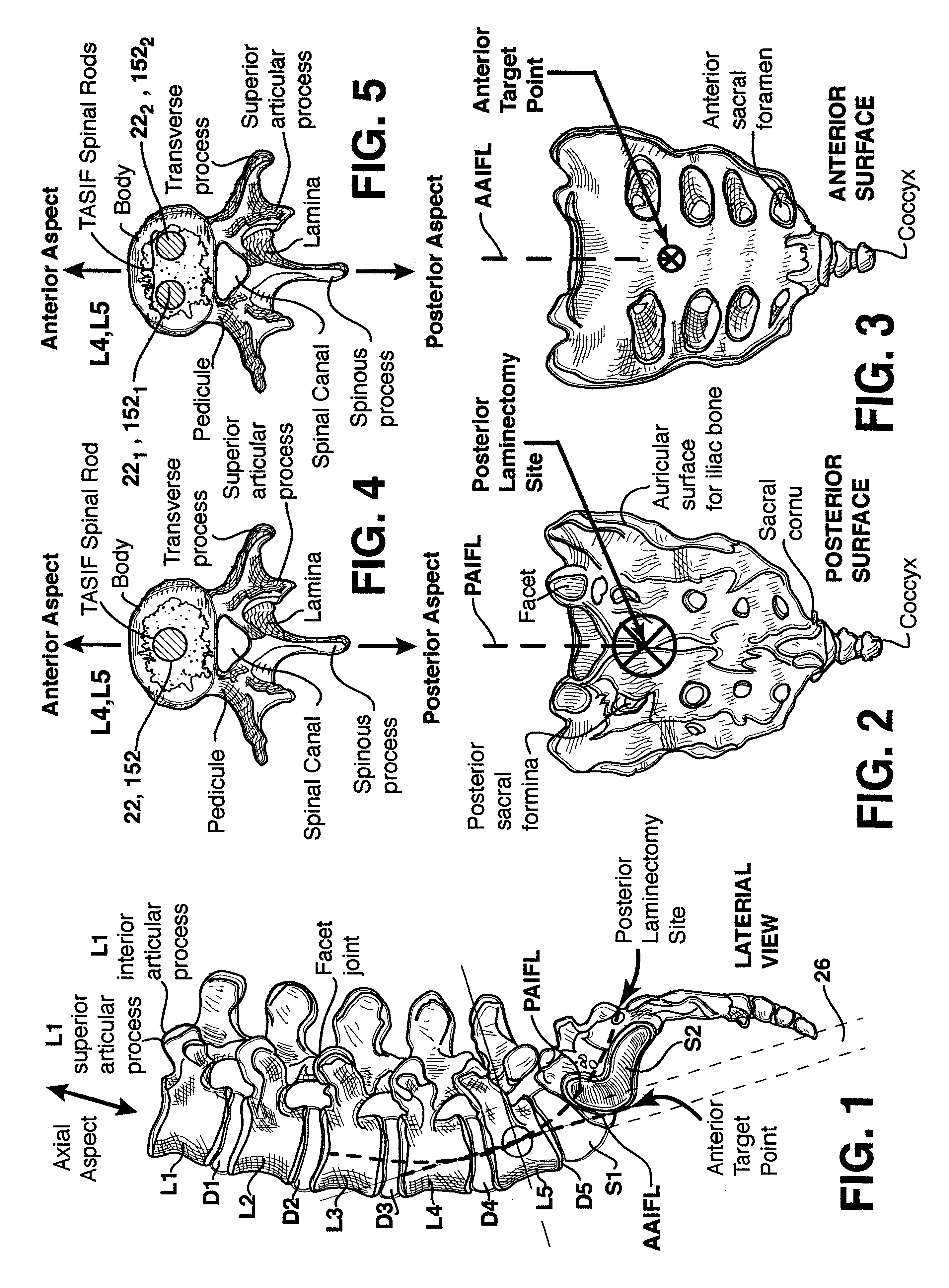 Methods and apparatus for forming shaped axial bores through spinal vertebrae