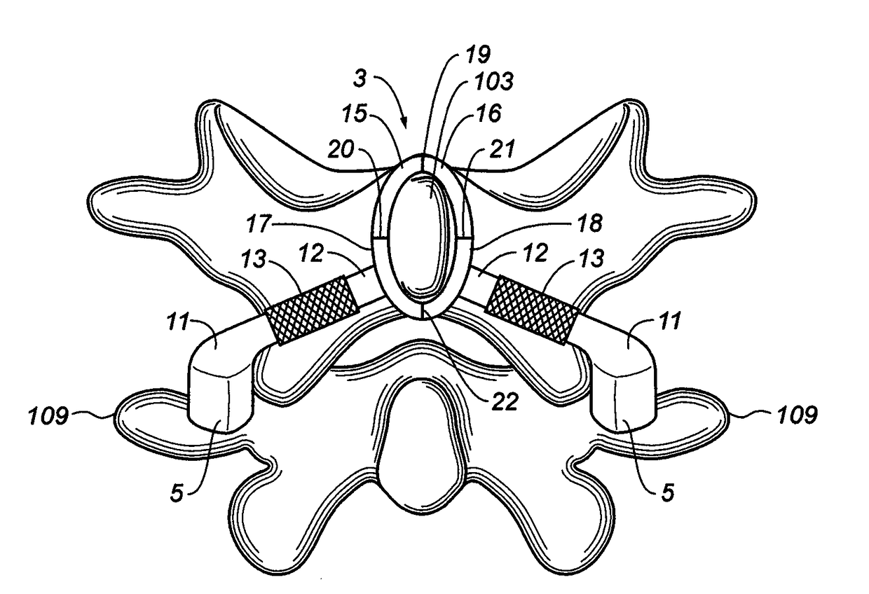 Spinal stabilization without implantation of hardware into the vertebrae proper or violation of cortical bone