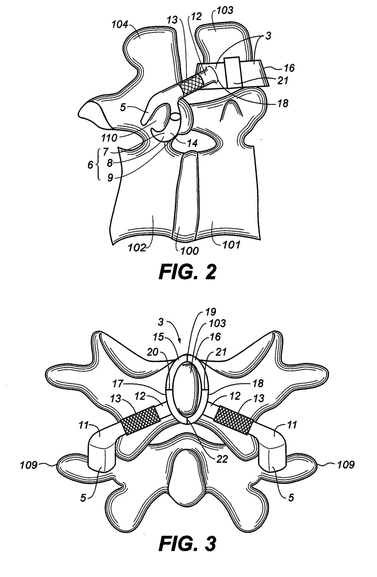 Spinal stabilization without implantation of hardware into the vertebrae proper or violation of cortical bone