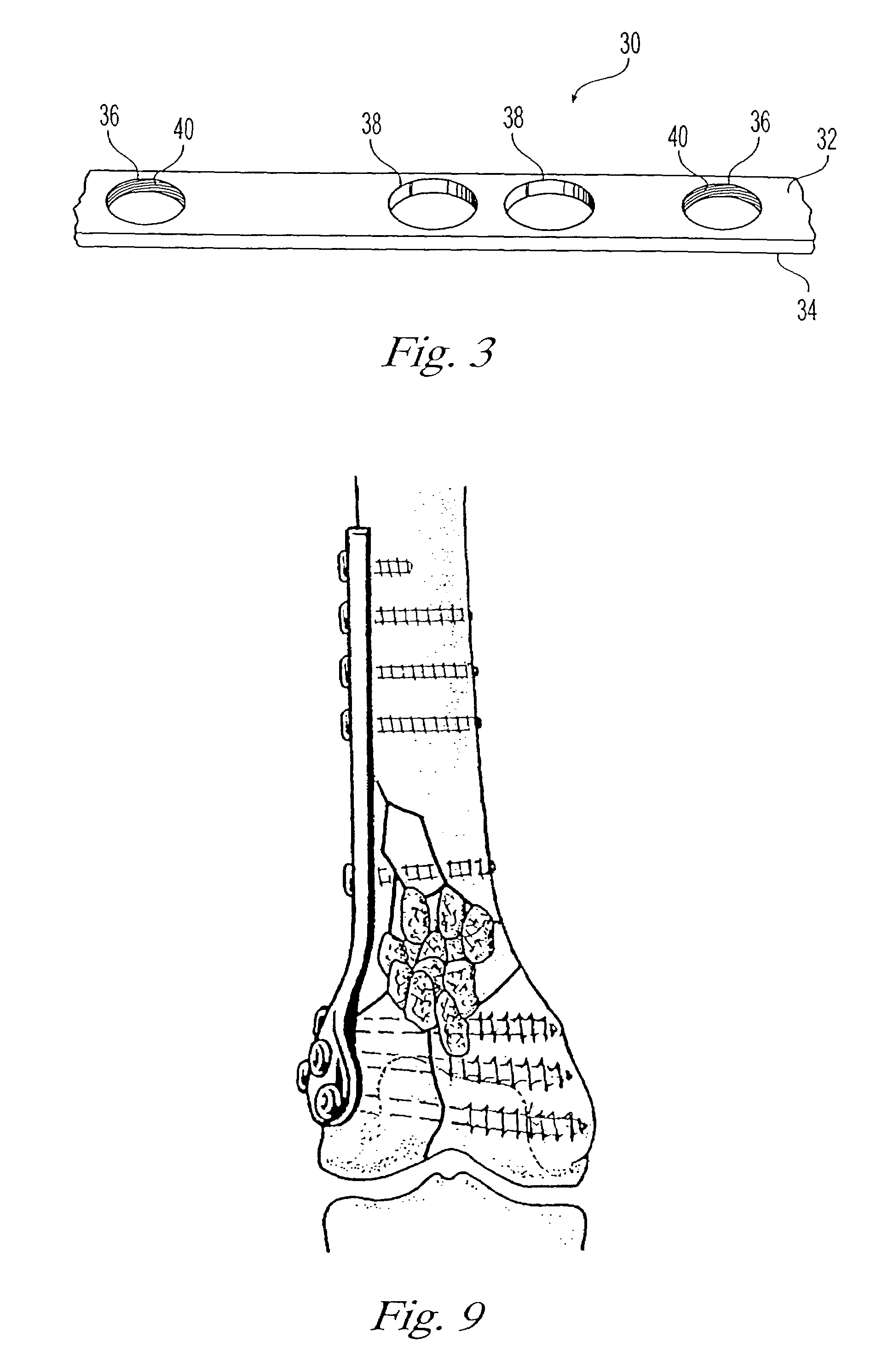 Bone plating system