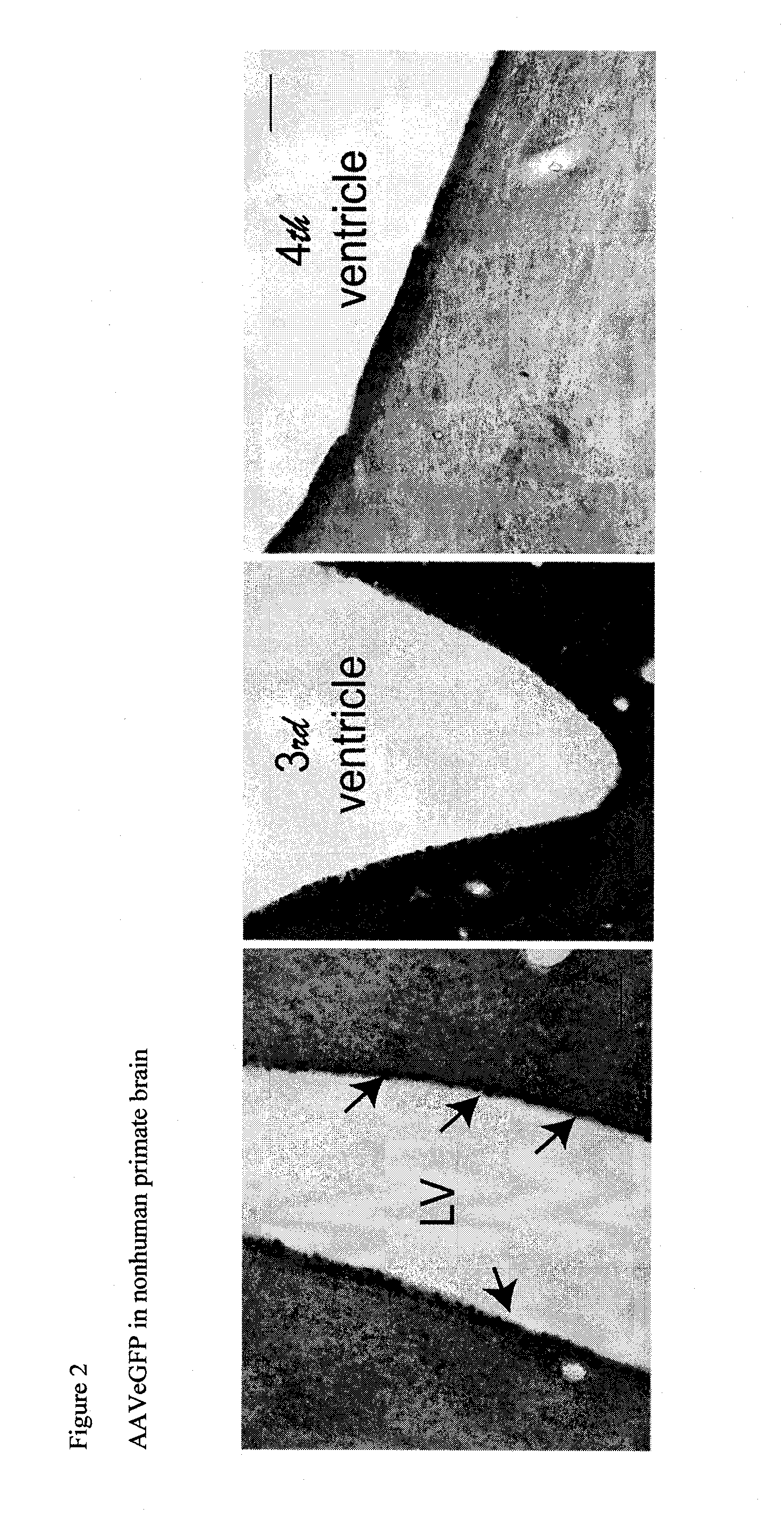 Methods and compositions for treating brain diseases