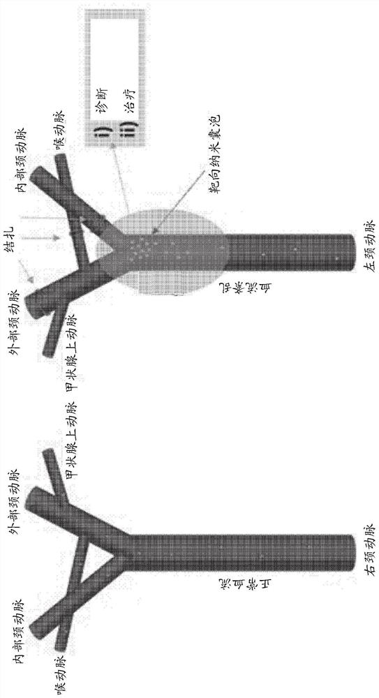 Method for diagnosing and treating arteriosclerosis using blood flow change site-targeted nanovesicles