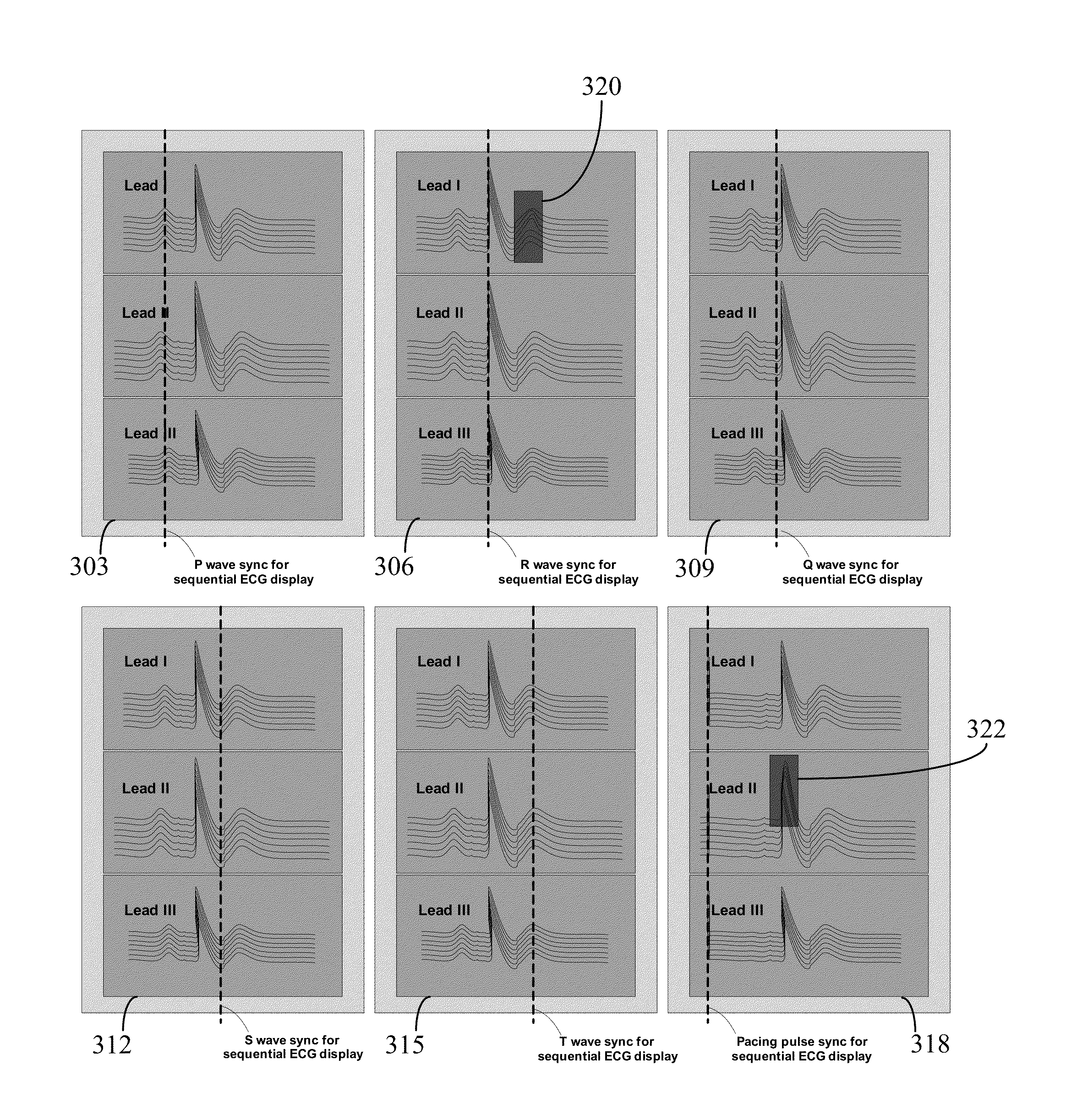 System for monitoring and diagnosis of cardiac electrogram signals using multi-dimensional analysis