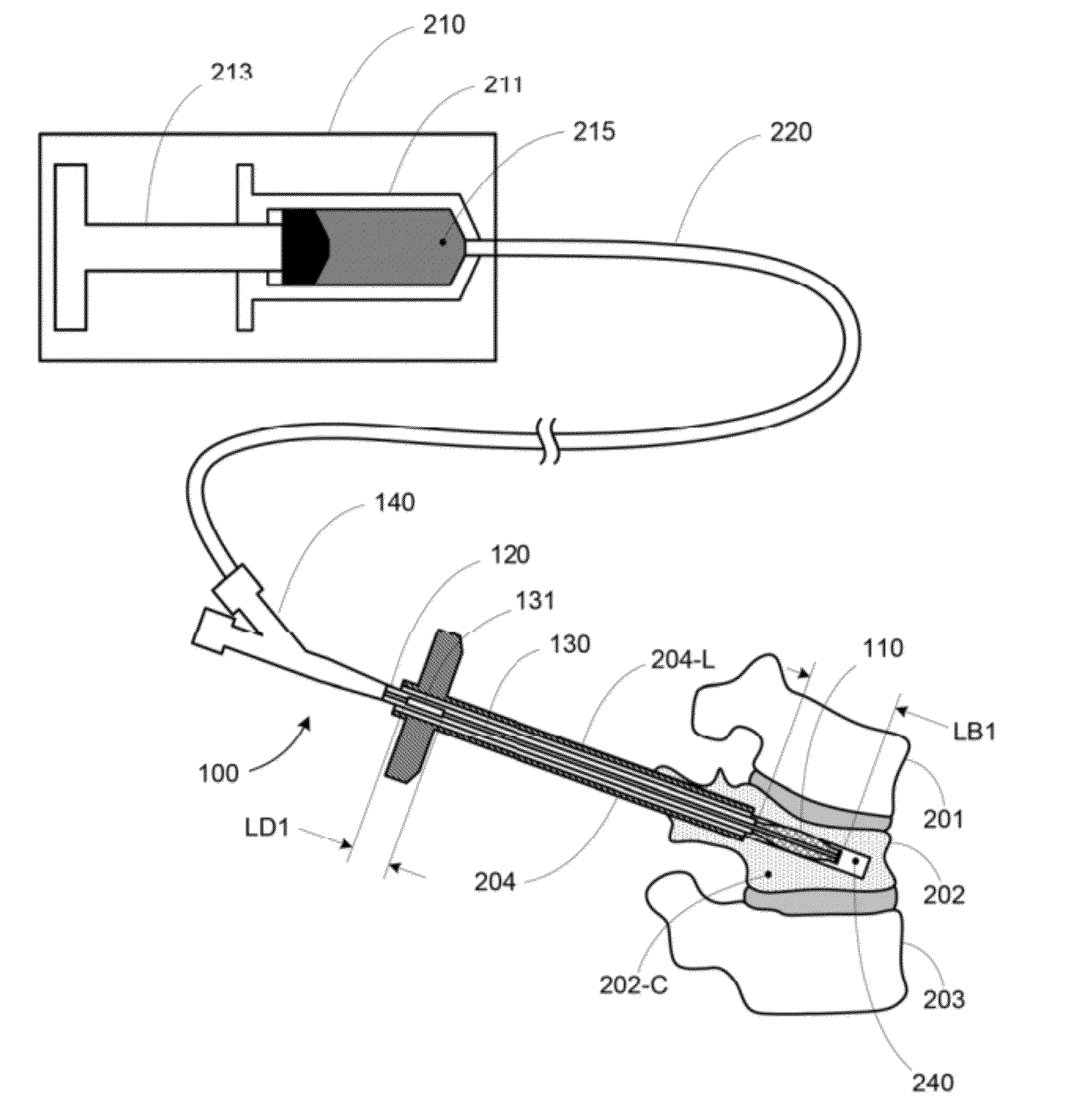 Inflatable bone TAMP with predetermined extensibility