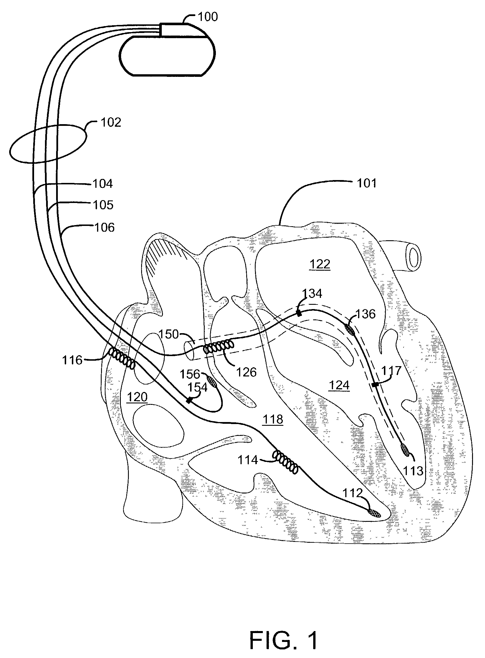Method and system for detecting capture using a coronary vein electrode