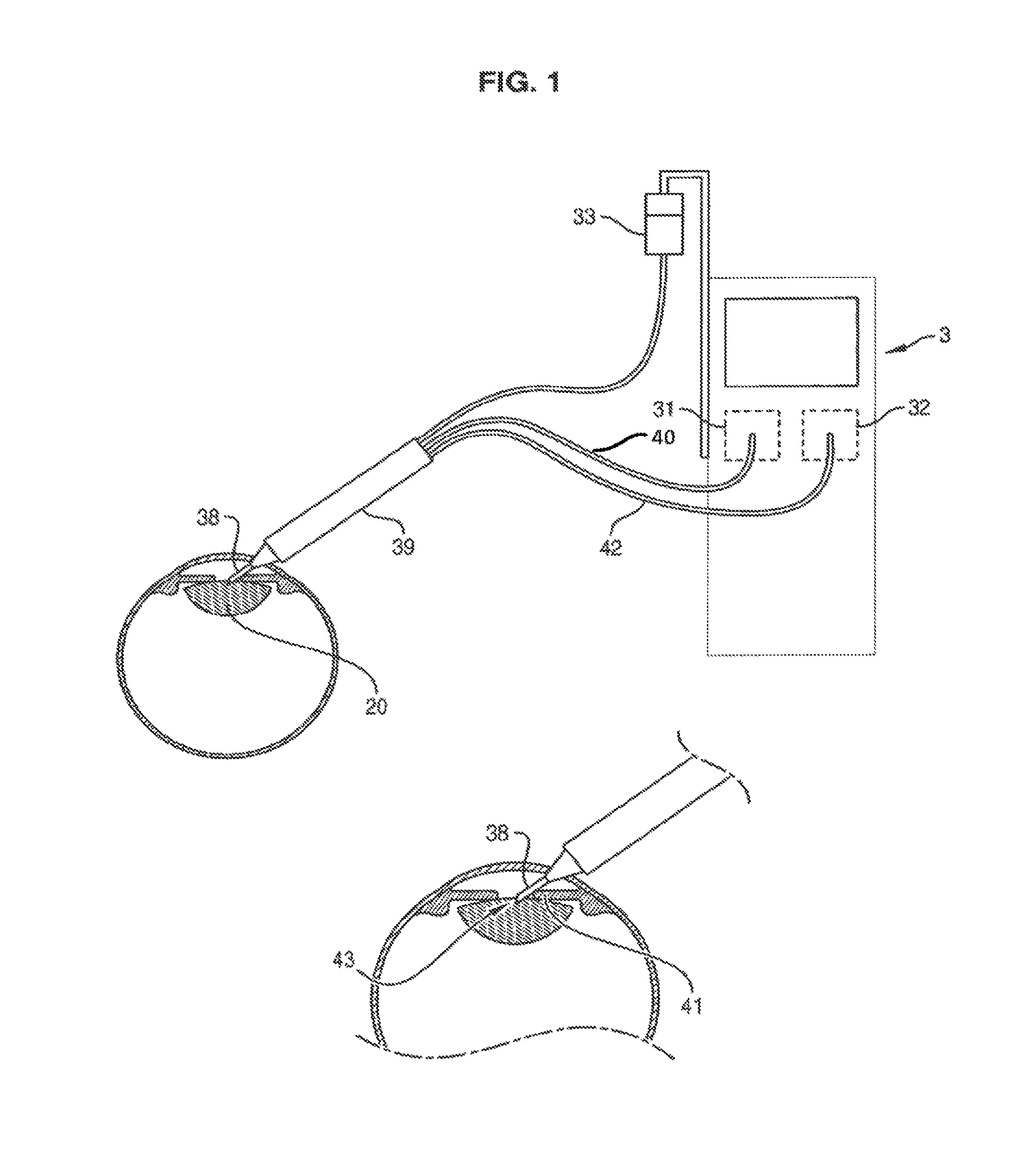 Method of treating an ocular pathology by applying ultrasound to the trabecular meshwork and device thereof