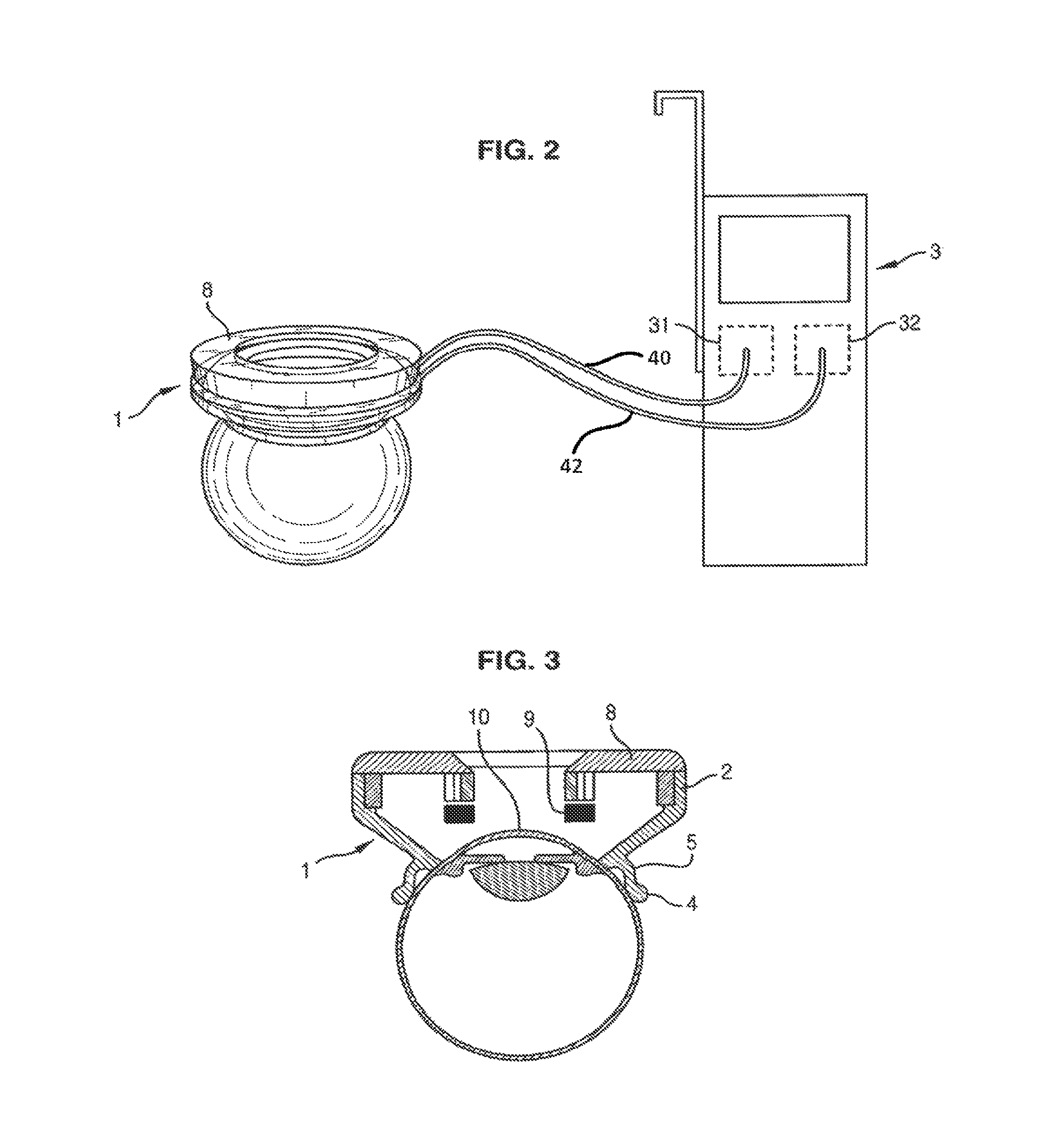 Method of treating an ocular pathology by applying ultrasound to the trabecular meshwork and device thereof