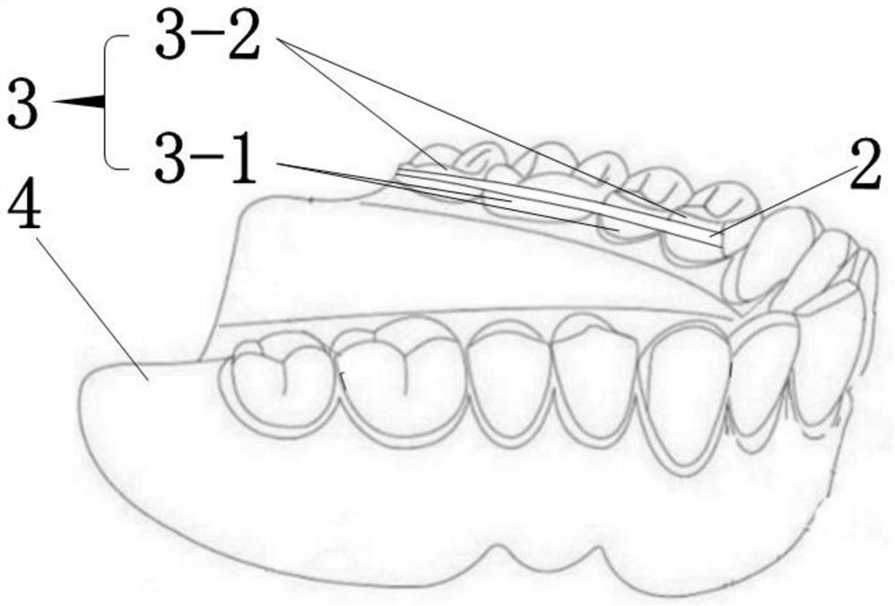 Denture repairing structure and method