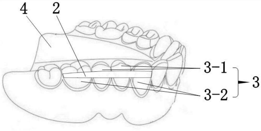 Denture repairing structure and method