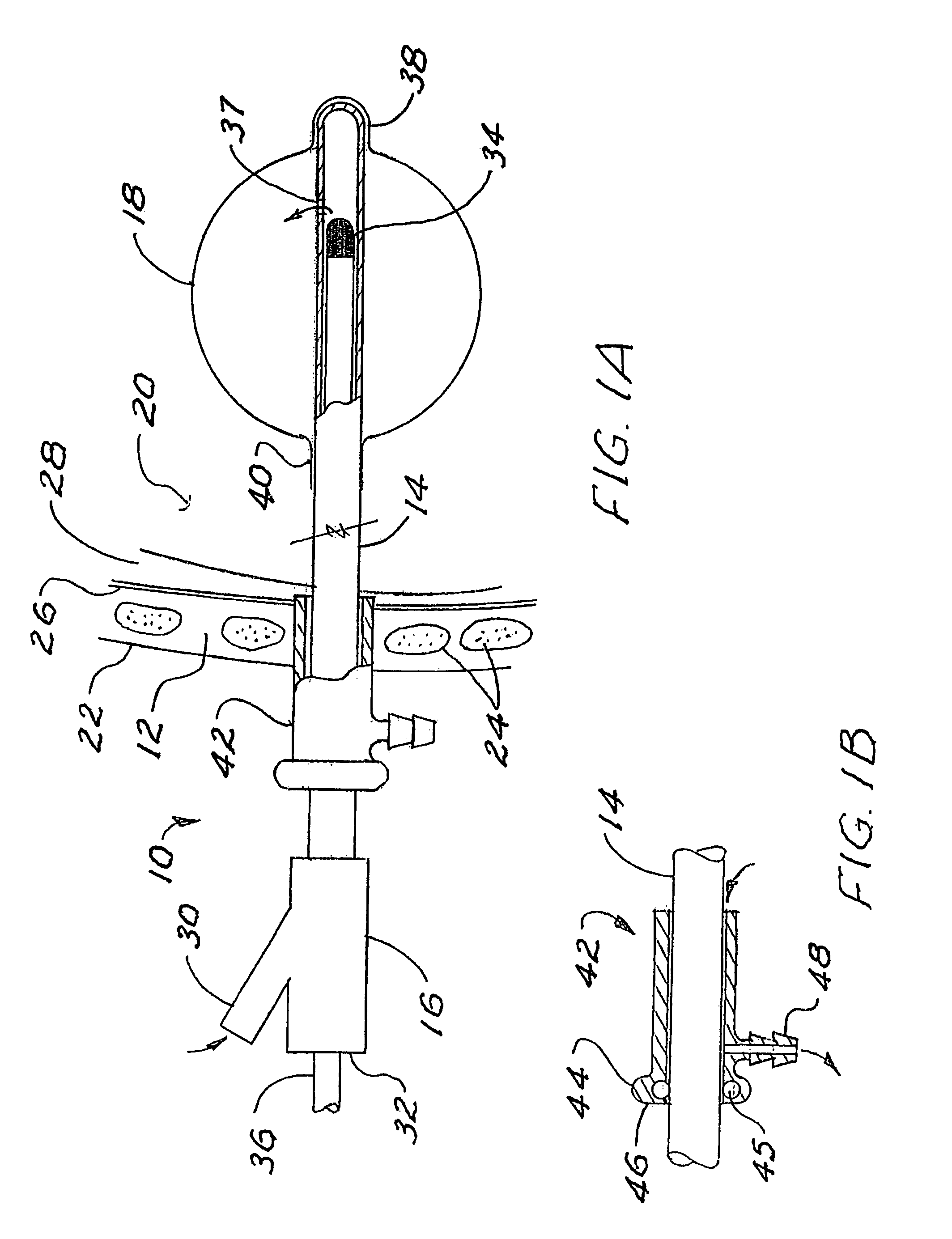 Brachytherapy apparatus and method for use with minimally invasive surgeries of the lung