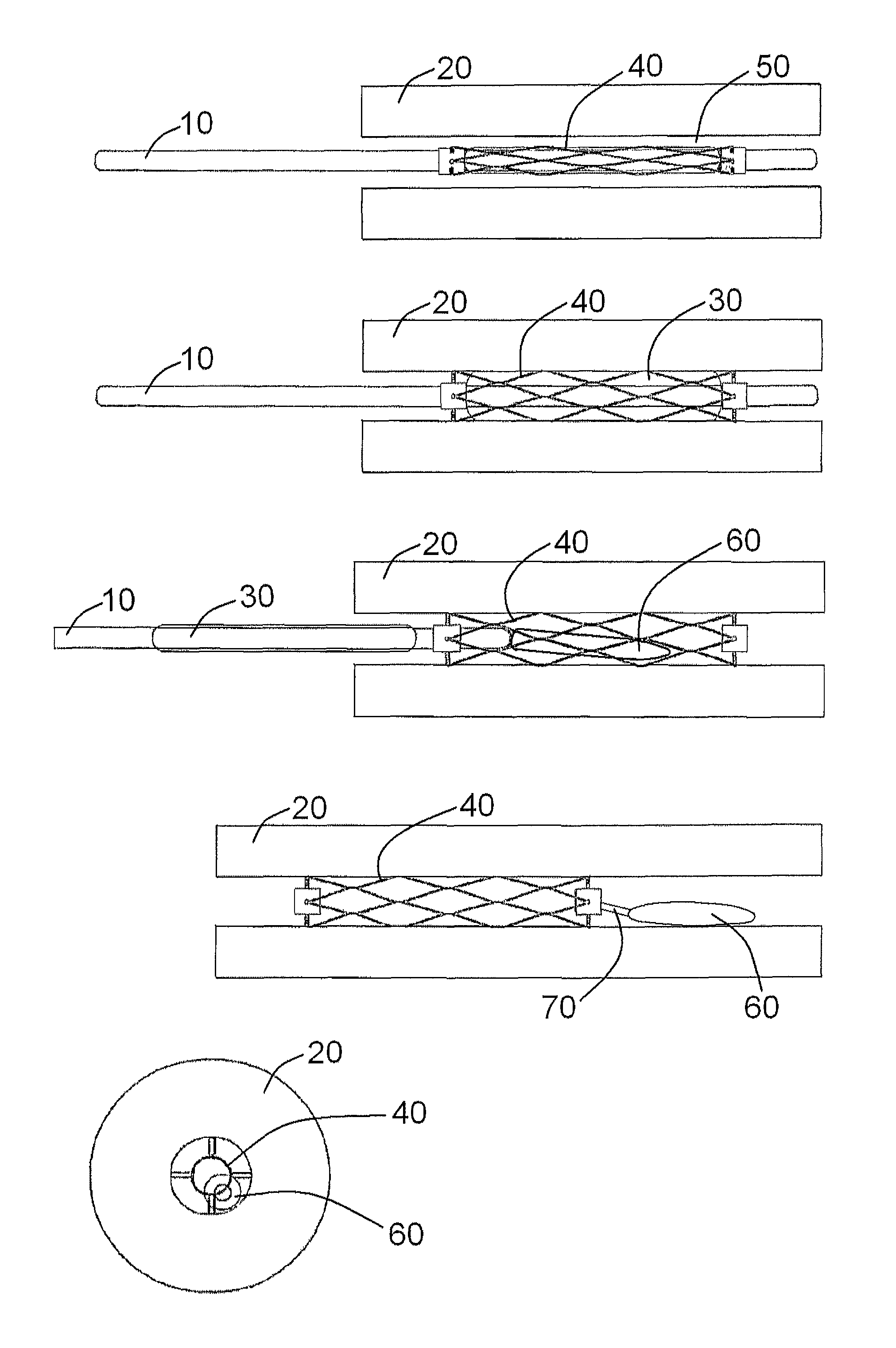 Devices, systems and methods for controlling local blood pressure
