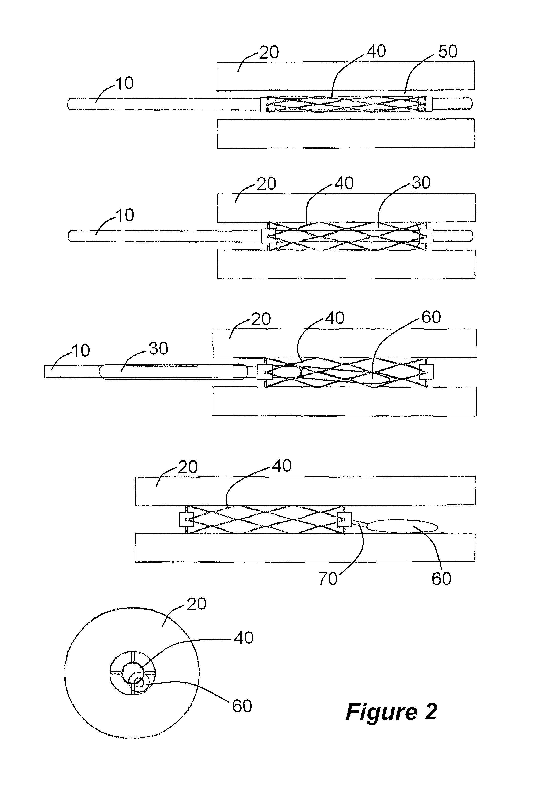 Devices, systems and methods for controlling local blood pressure