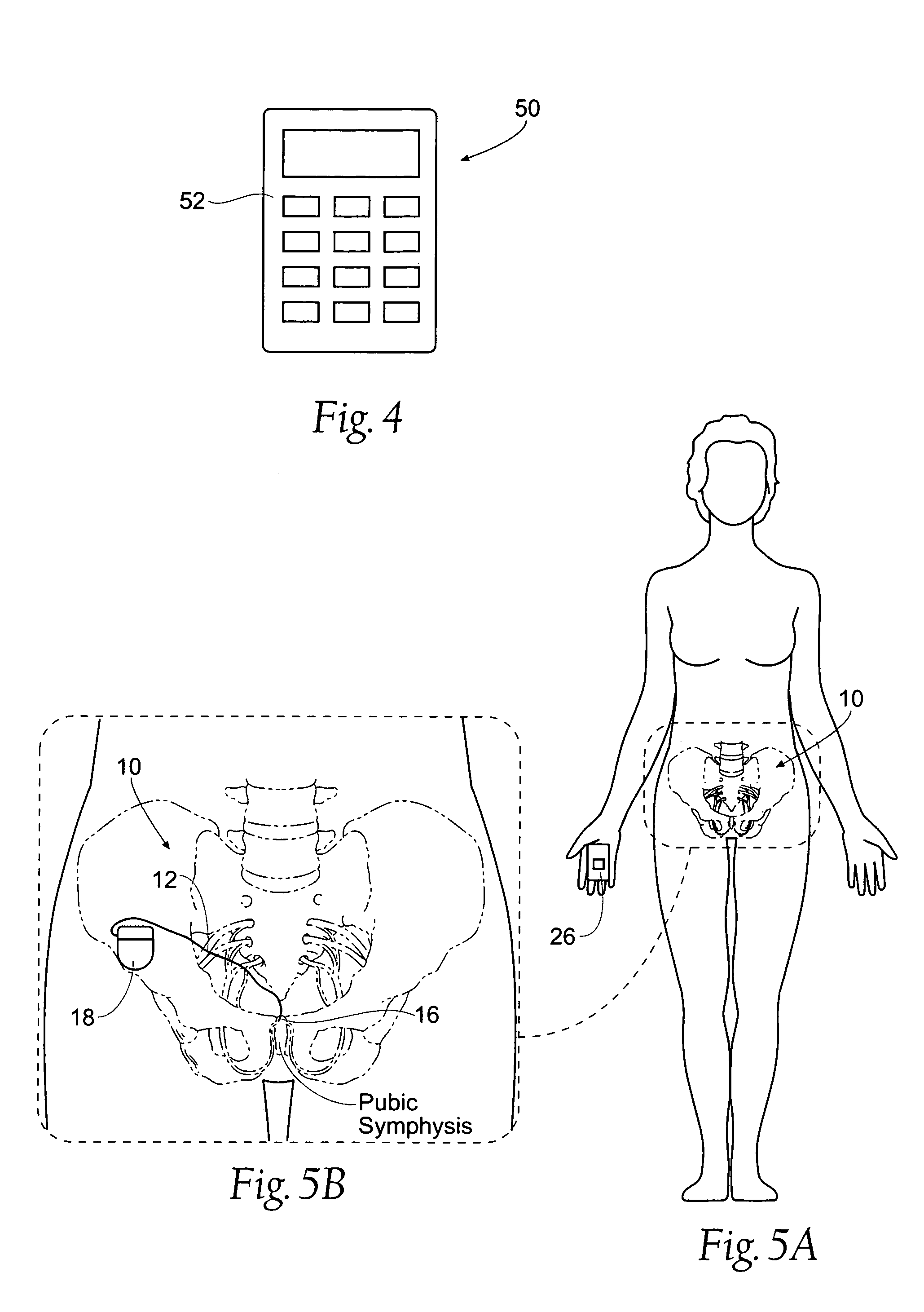 Method for affecting urinary function with electrode implantation in adipose tissue