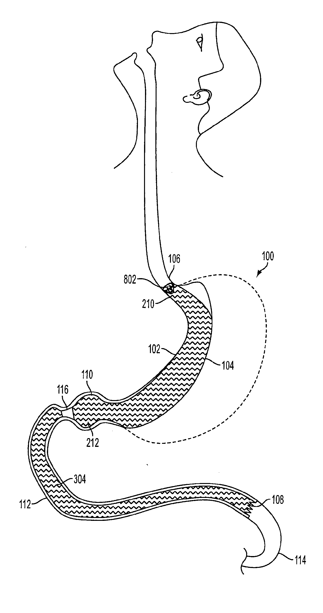 Method and apparatus for treating obesity and controlling weight gain and absorption of glucose in mammals