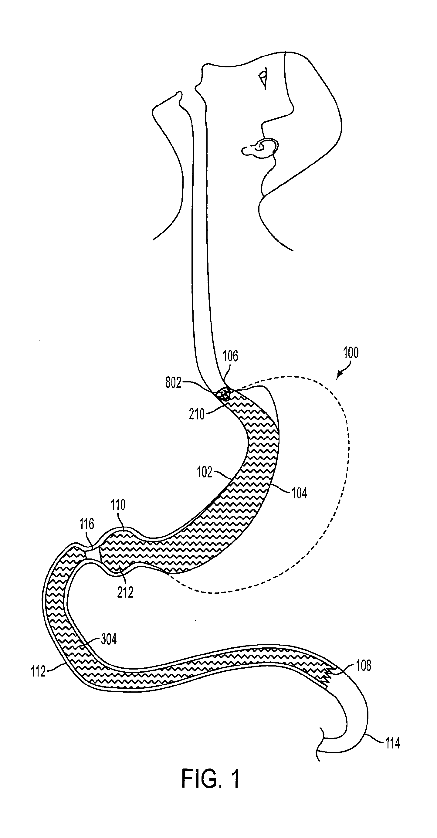 Method and apparatus for treating obesity and controlling weight gain and absorption of glucose in mammals