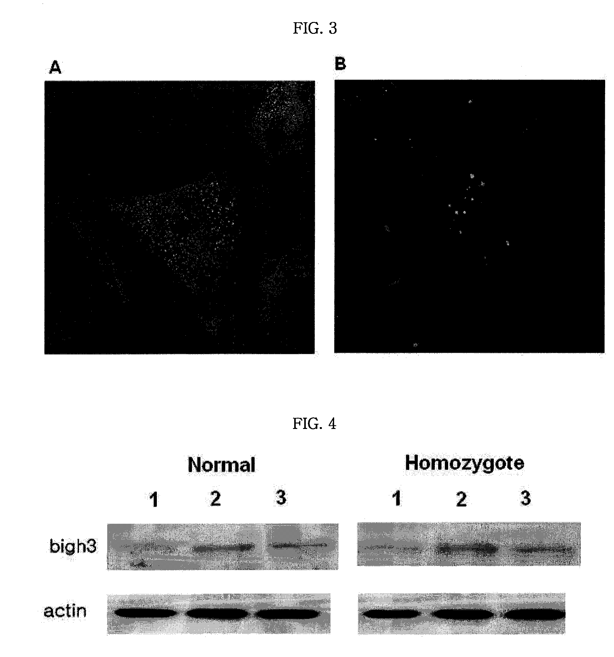 Pharmaceutical Composition for Treating Avellino Cornea Dystrophy Comprising an Antibody Against Tgf-Beta