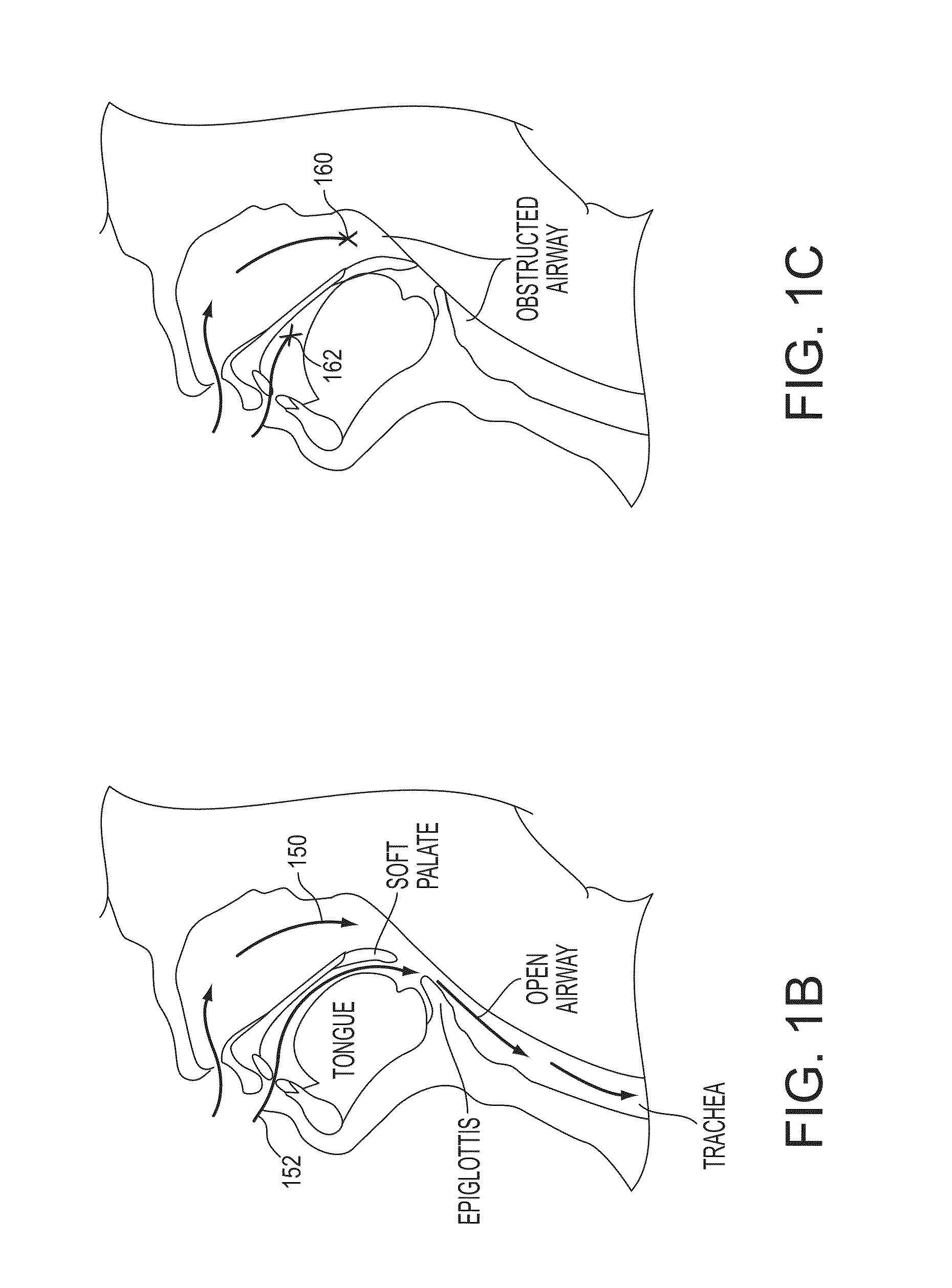 Systems, methods and devices for diagnosing sleep apnea