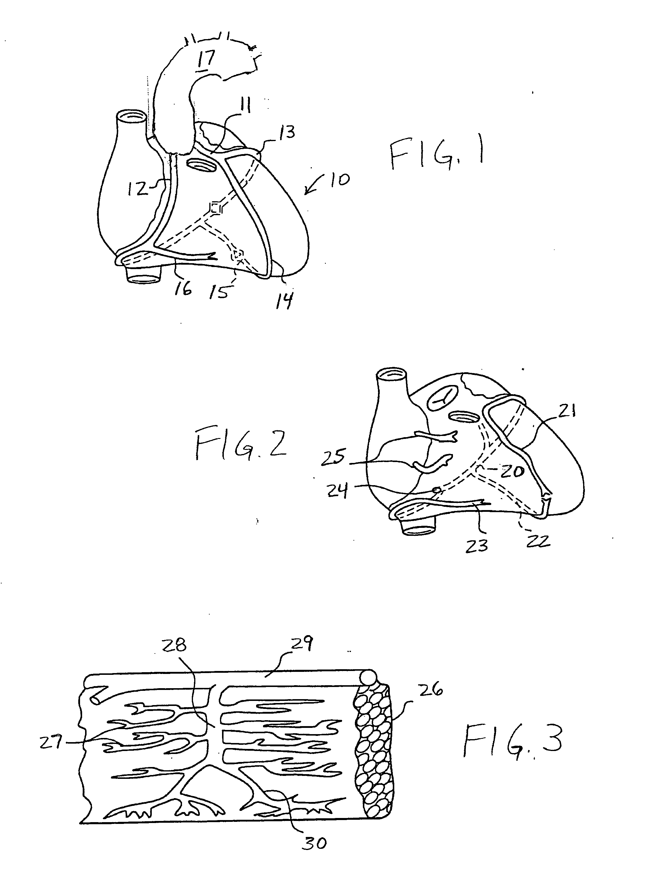 Methods and apparatus for treating infarcted regions of tissue following acute myocardial infarction
