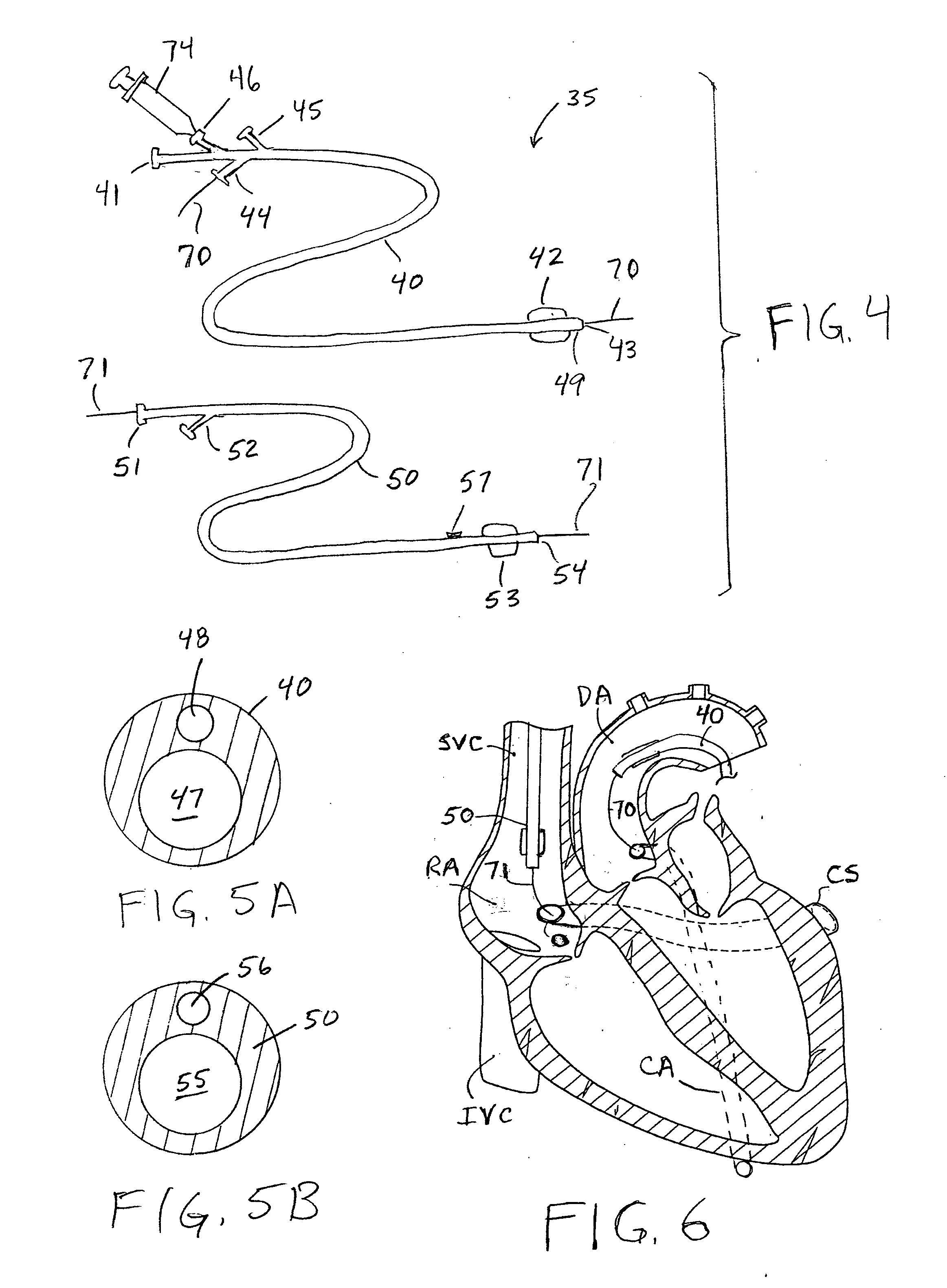 Methods and apparatus for treating infarcted regions of tissue following acute myocardial infarction