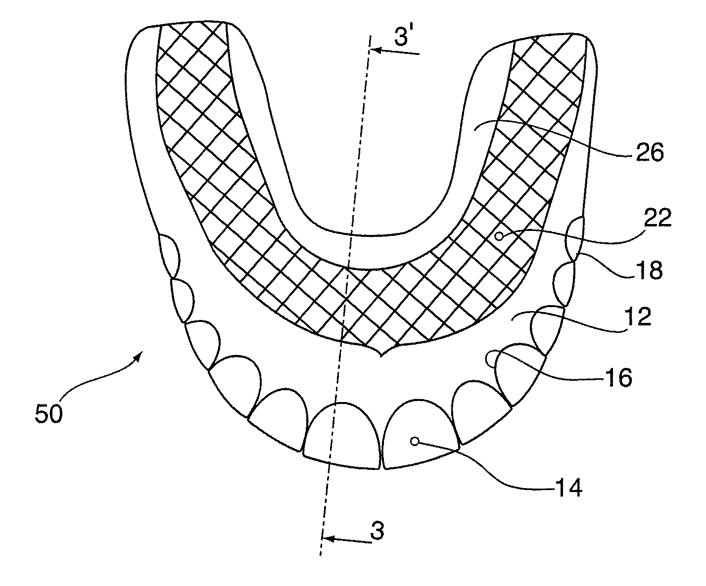 Palate-Free Upper Denture