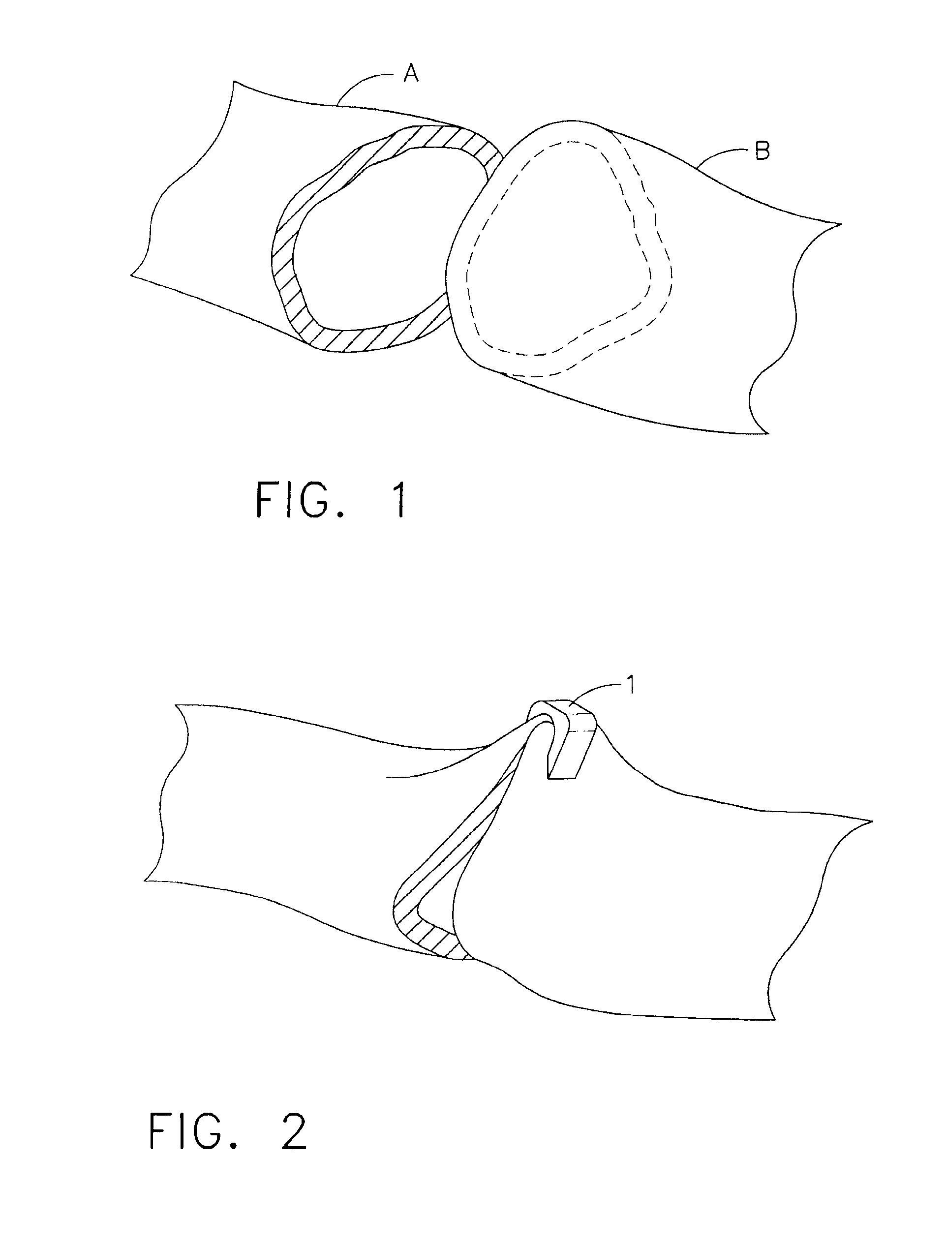 Method and Device for Effecting Anastomosis of Hollow Organ Structures Using Adhesive and Fasteners