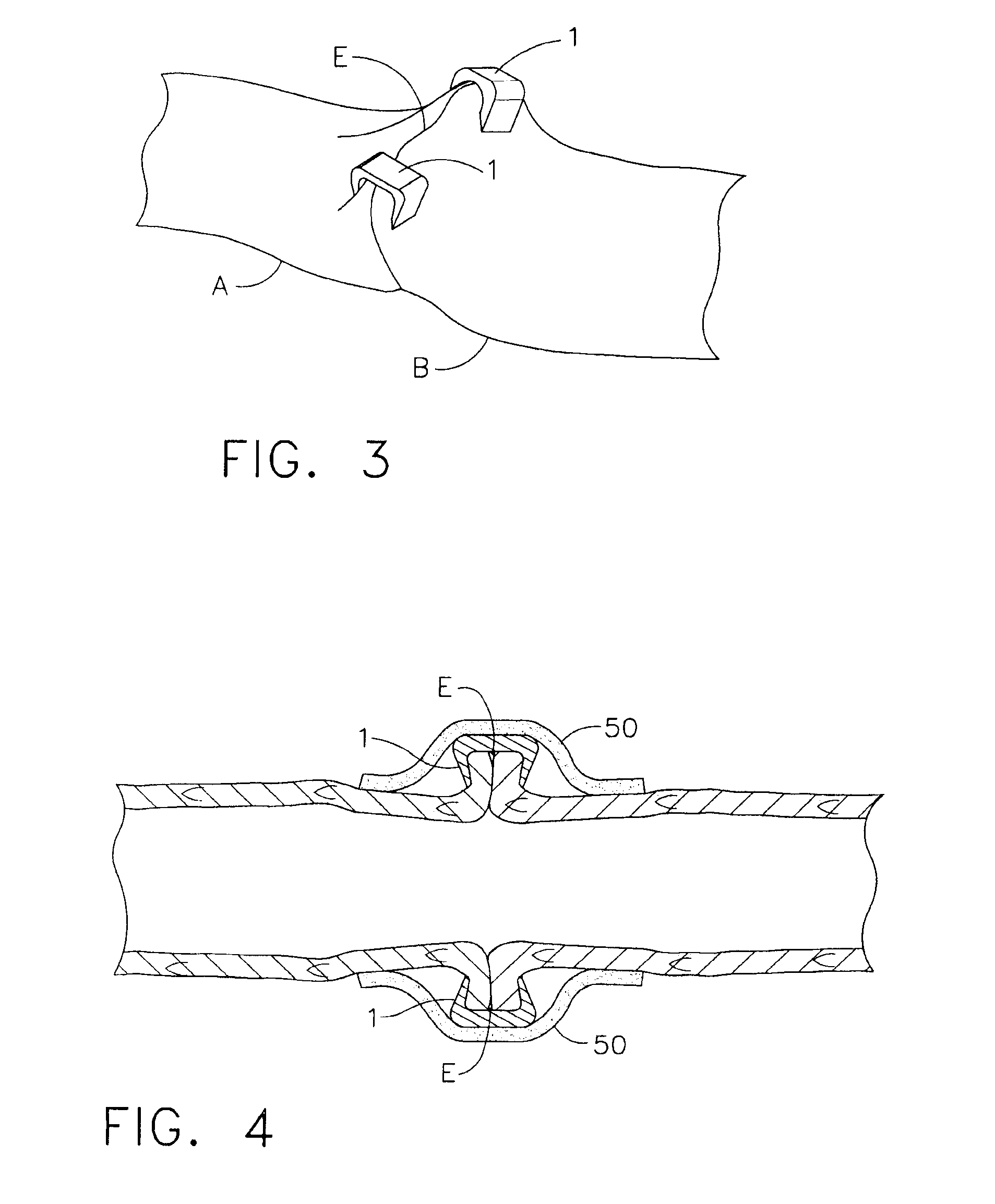 Method and Device for Effecting Anastomosis of Hollow Organ Structures Using Adhesive and Fasteners