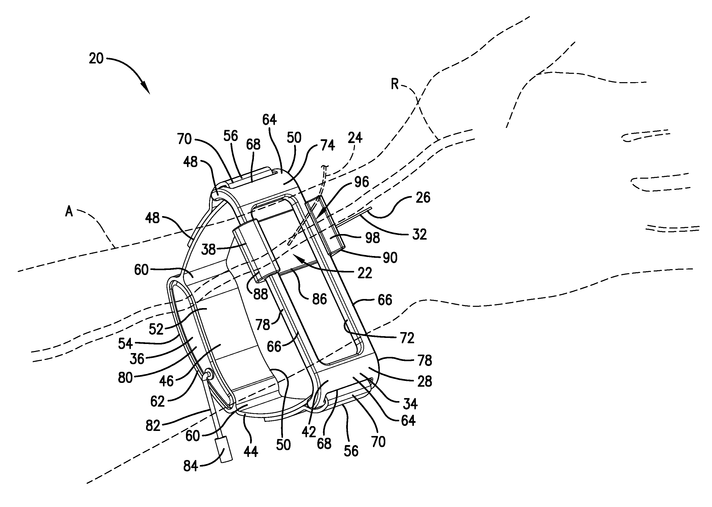 Radial compression hemostasis band with Doppler confirming vascular patency